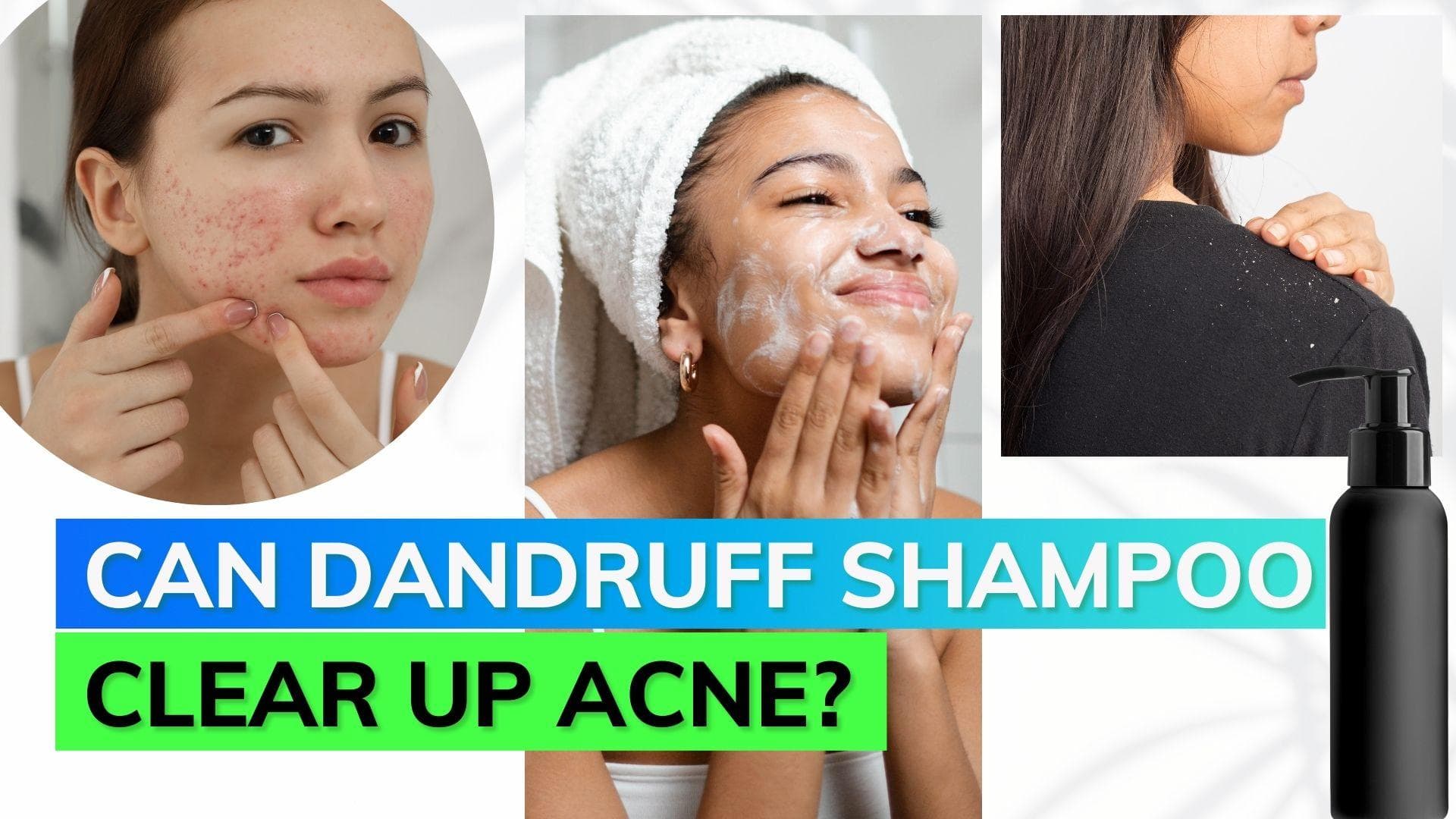Dandruff shampoo to treat acne: miracle or hoax? 