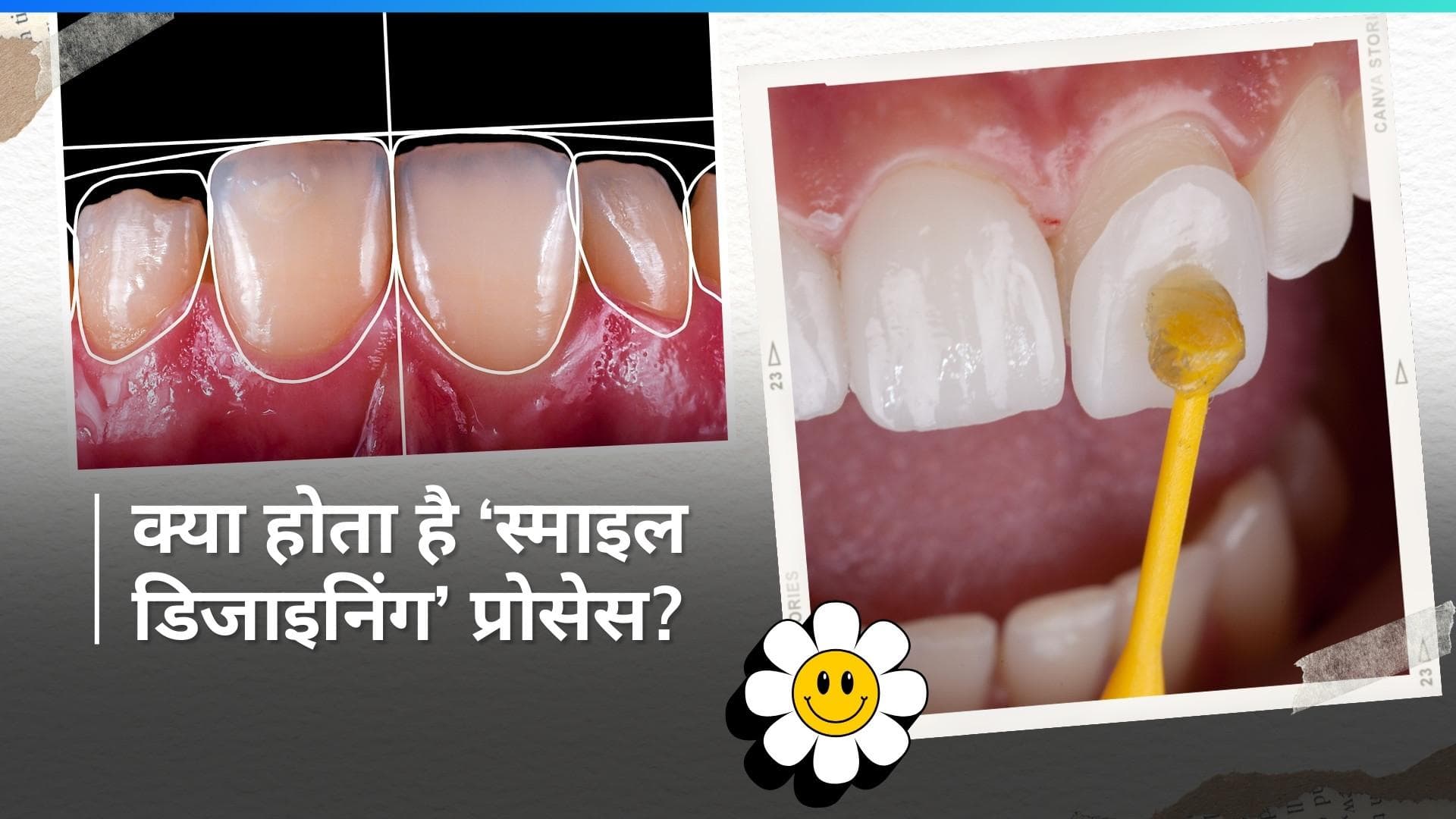 Smile Designing Process: शादी से पहले शख्स ने कराई 'स्माइल डिजाइनिंग', प्रोसीजर के दौरान हुई मौत