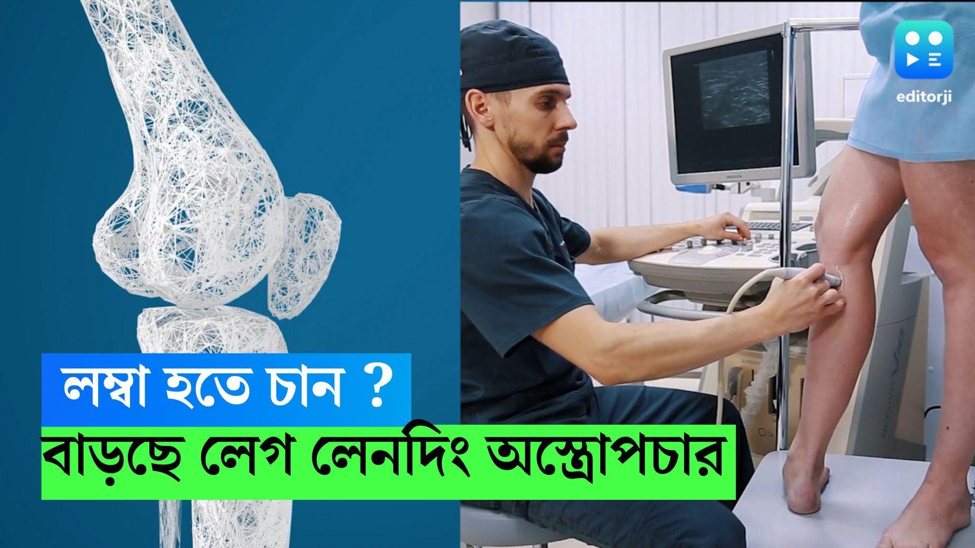 Leg lengthing Surgery : লম্বা হতে চান ? পুরুষদের মধ্যে লেগ লেনদিং অস্ত্রোপচারের জনপ্রিয়তা বাড়ছে এই দেশে
