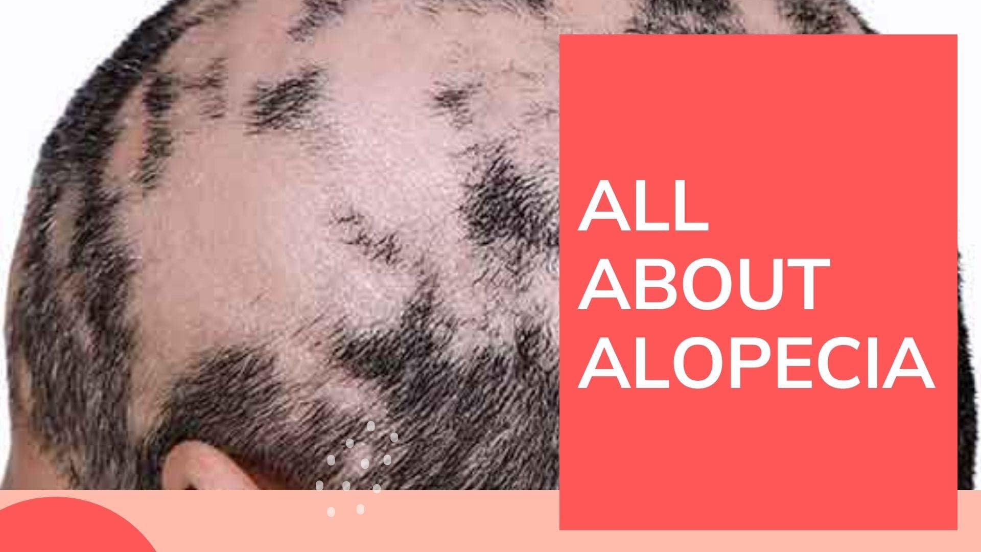 Explained | What is alopecia, the condition Jada Pinkett Smith suffers from?