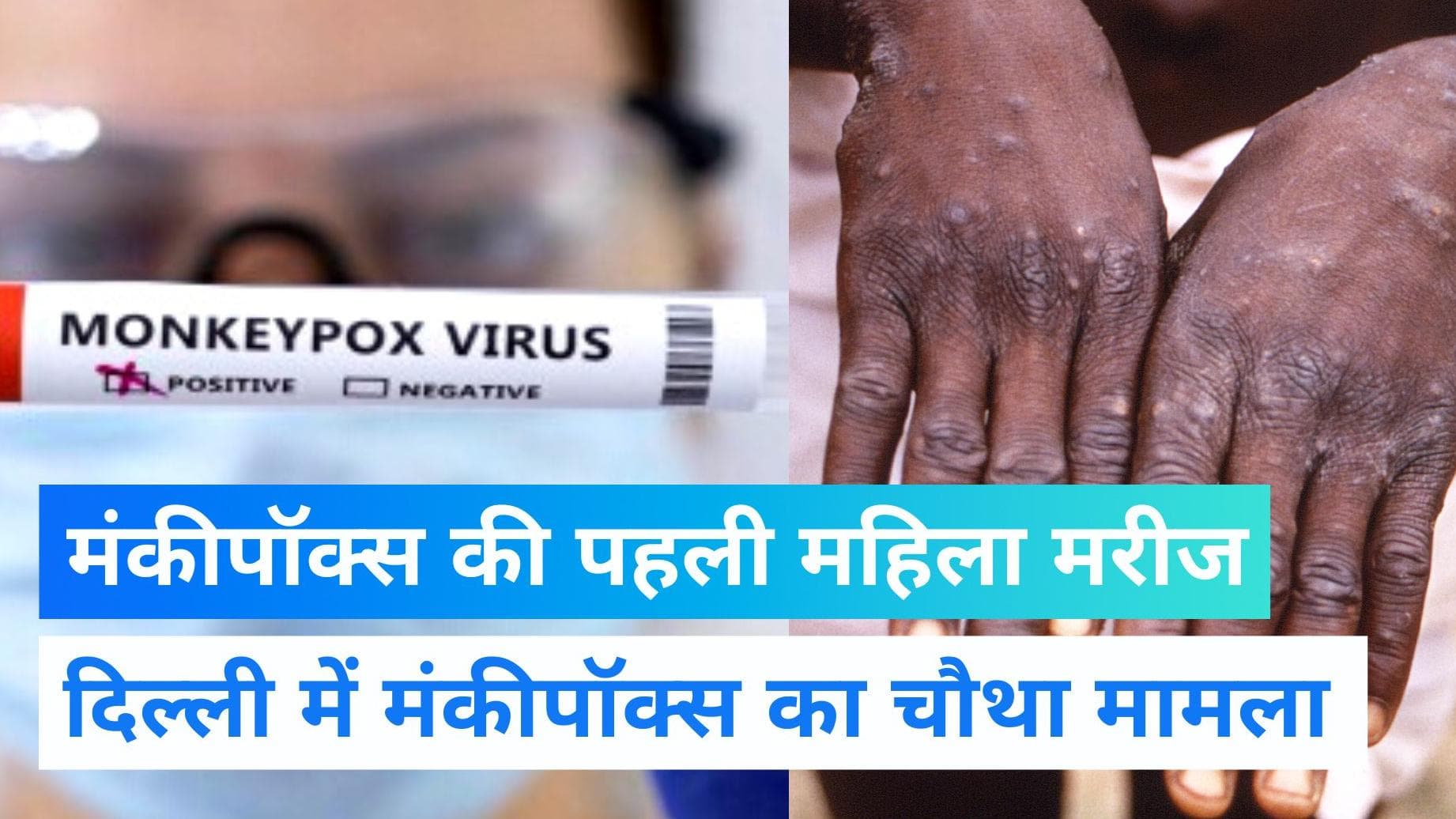 Monkeypox in Delhi: 31 साल की नाइजीरियाई महिला निकली पॉजिटिव,देश में महिलाओं में संक्रमण का पहला केस
