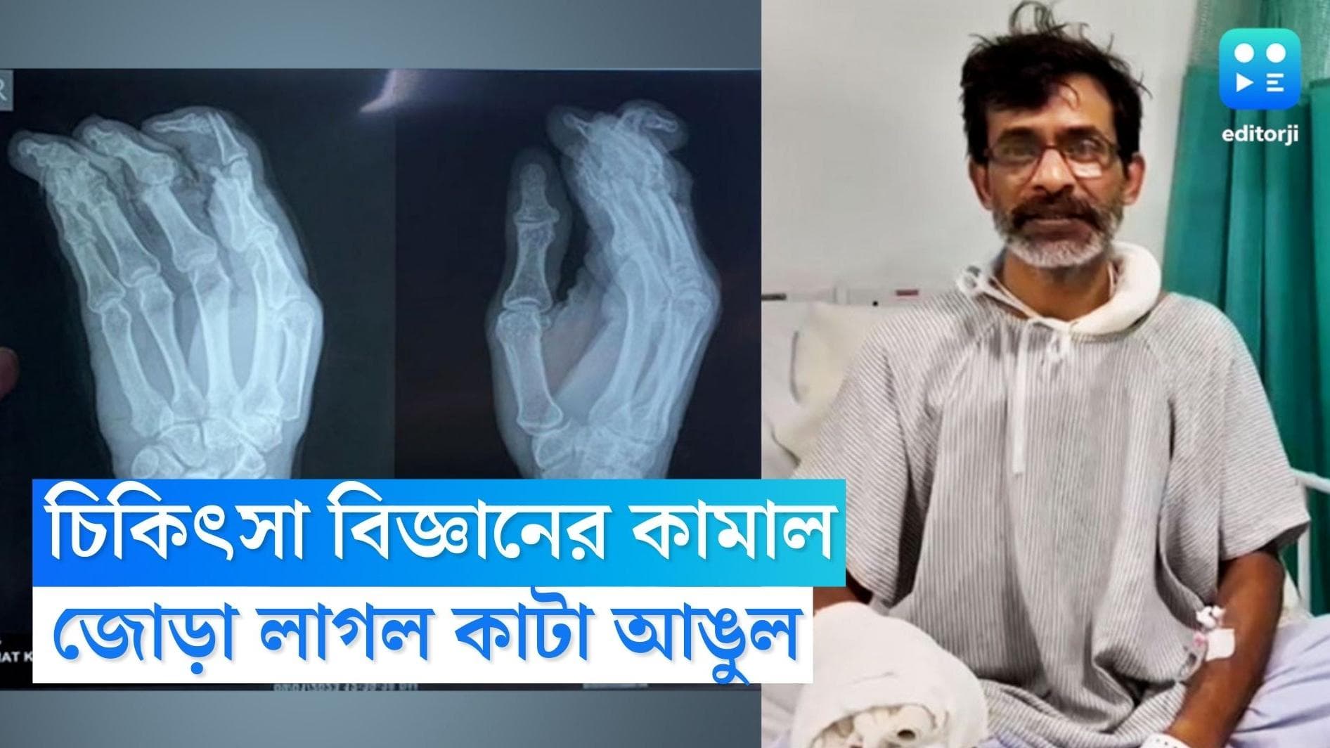 Viral Surgery in Kolkata: চিকিৎসাবিজ্ঞানের সাফল্য, কলকাতায় এসে কাটা আঙুল জুড়লো নদিয়ার বাসিন্দার