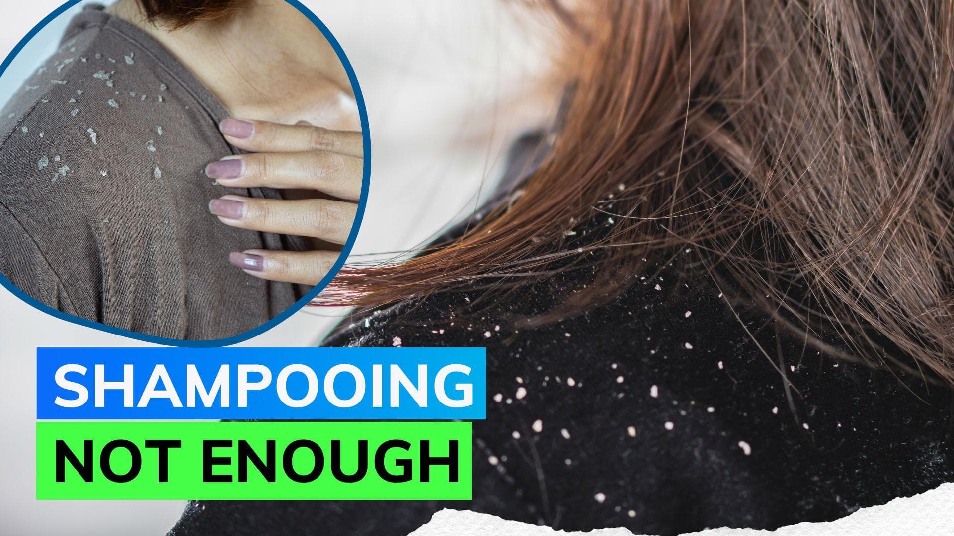 Dandruff: Experts share tips and tricks that can help combat itchy scalp 