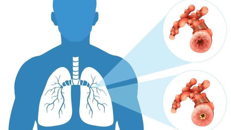 Acute Bronchitis: नॉर्मल खांसी और ज़ुकाम से कैसे अलग है ब्रोंकाइटिस, जानिये लक्षण और उपचार