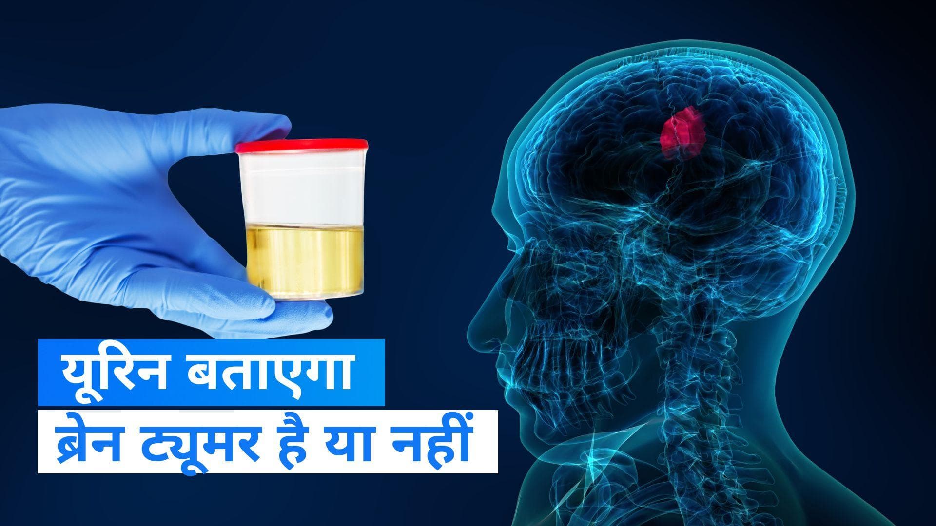 Brain Tumor: यूरिन से भी पता लगेगा कि ब्रेन ट्यूमर है या नहीं, वैज्ञानिकों का दावा