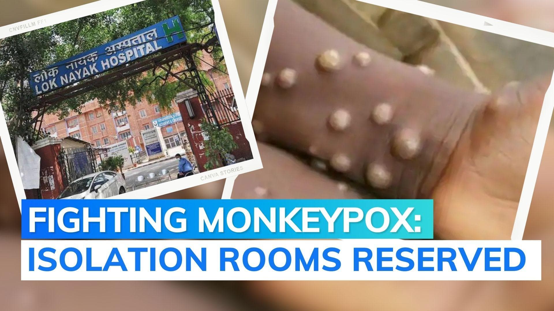 Monekypox in India: Delhi reports third case, govt designates hospitals