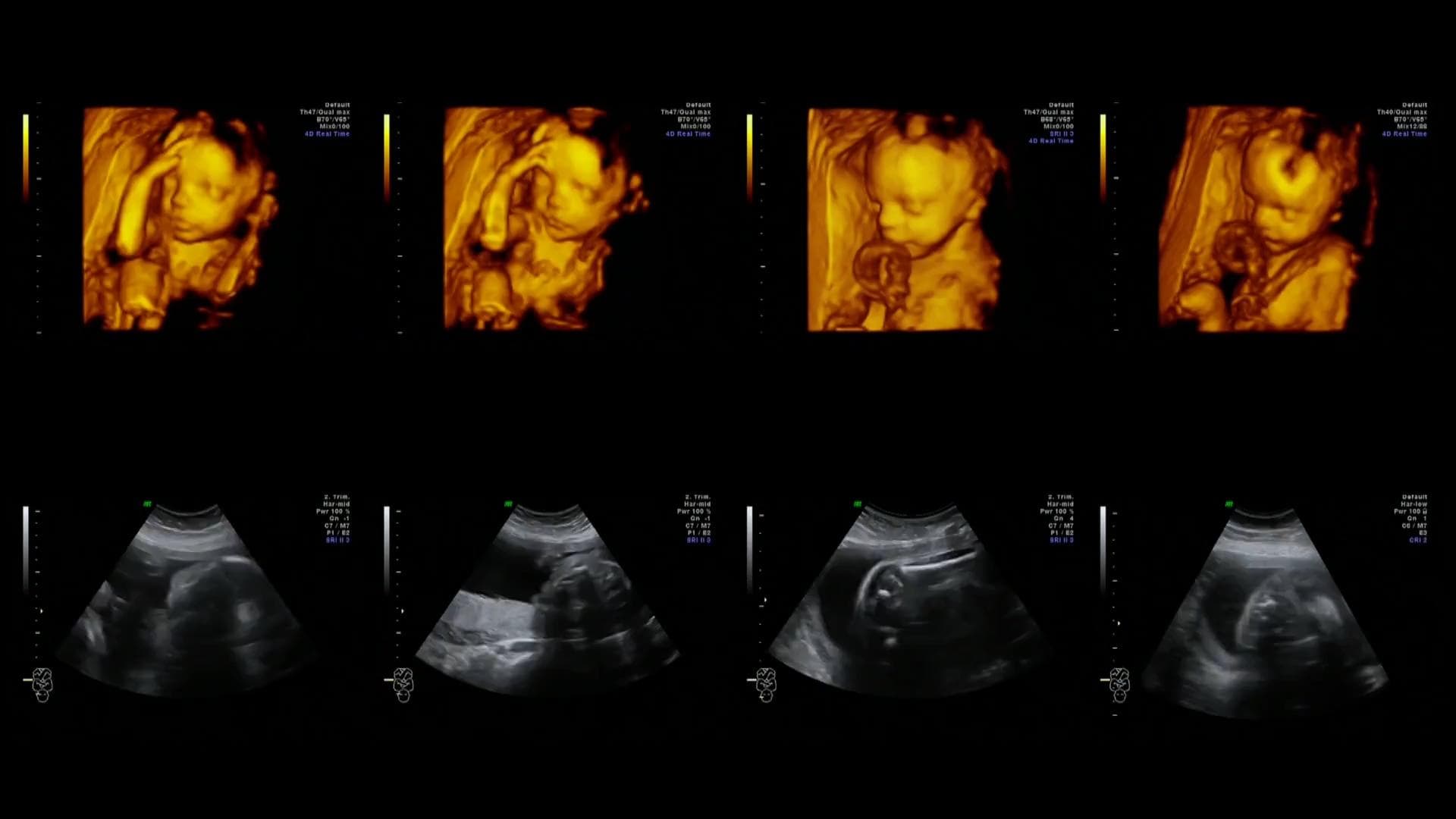 Microplastics found in unborn babies' placentas: study 