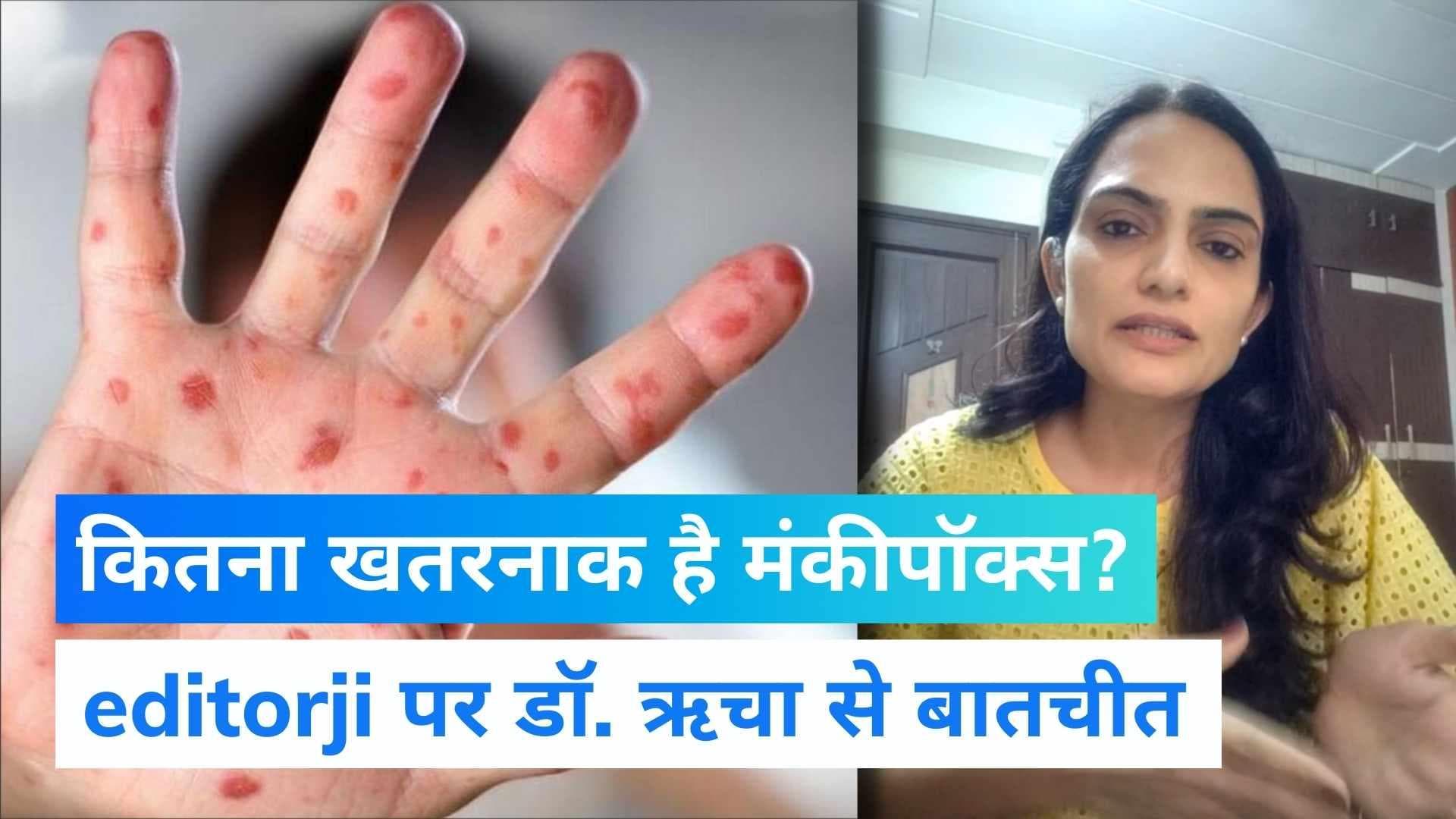 Monkeypox कितना खतरनाक? भारत में पहले मरीज का डायग्नोसिस करने वाली डॉ. ऋचा चौधरी से जानिए