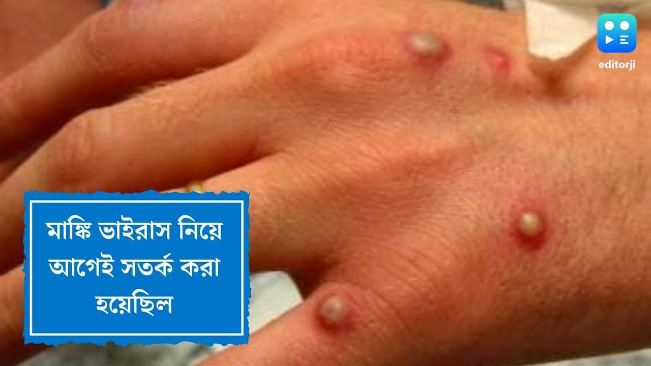 Monkey Virus alert:মাঙ্কি ভাইরাস নিয়ে সতর্কতা ছিল আগেই, গুরুত্ব দেয়নি কেউ