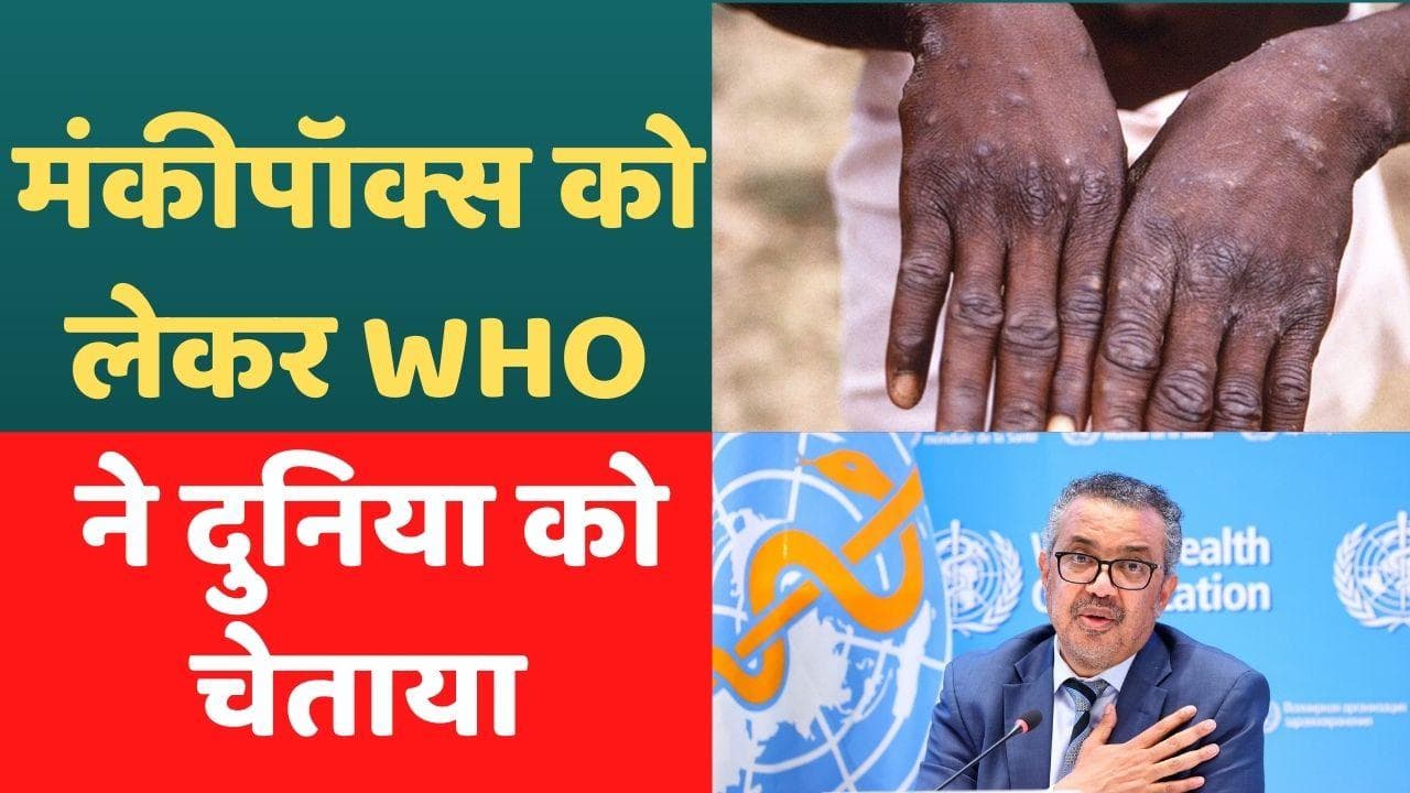Monkeypox Virus: मंकीपॉक्स को लेकर WHO ने दी चेतावनी, कहा- स्थिति बिगड़ रही है, सावधान रहें लोग