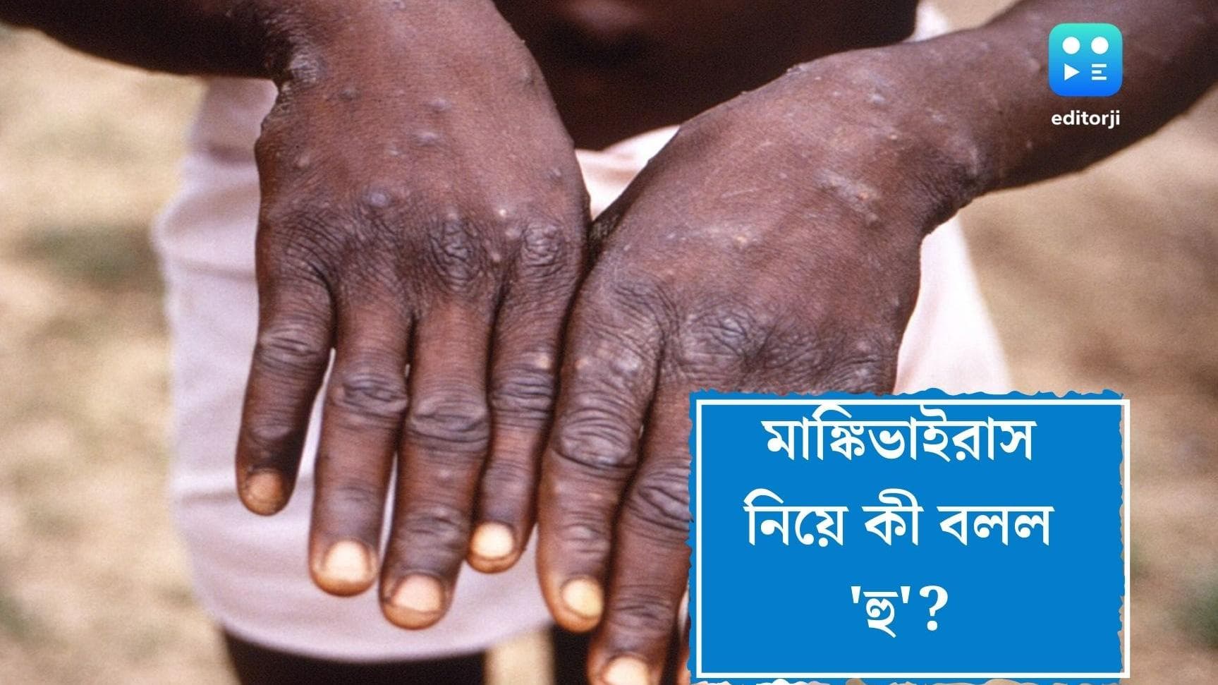 WHO on Monkey Virus: অতিমারীর প্রকোপ নেই, এমন দেশে মাঙ্কি ভাইরাস আটকানো সম্ভব, মনে করছে WHO