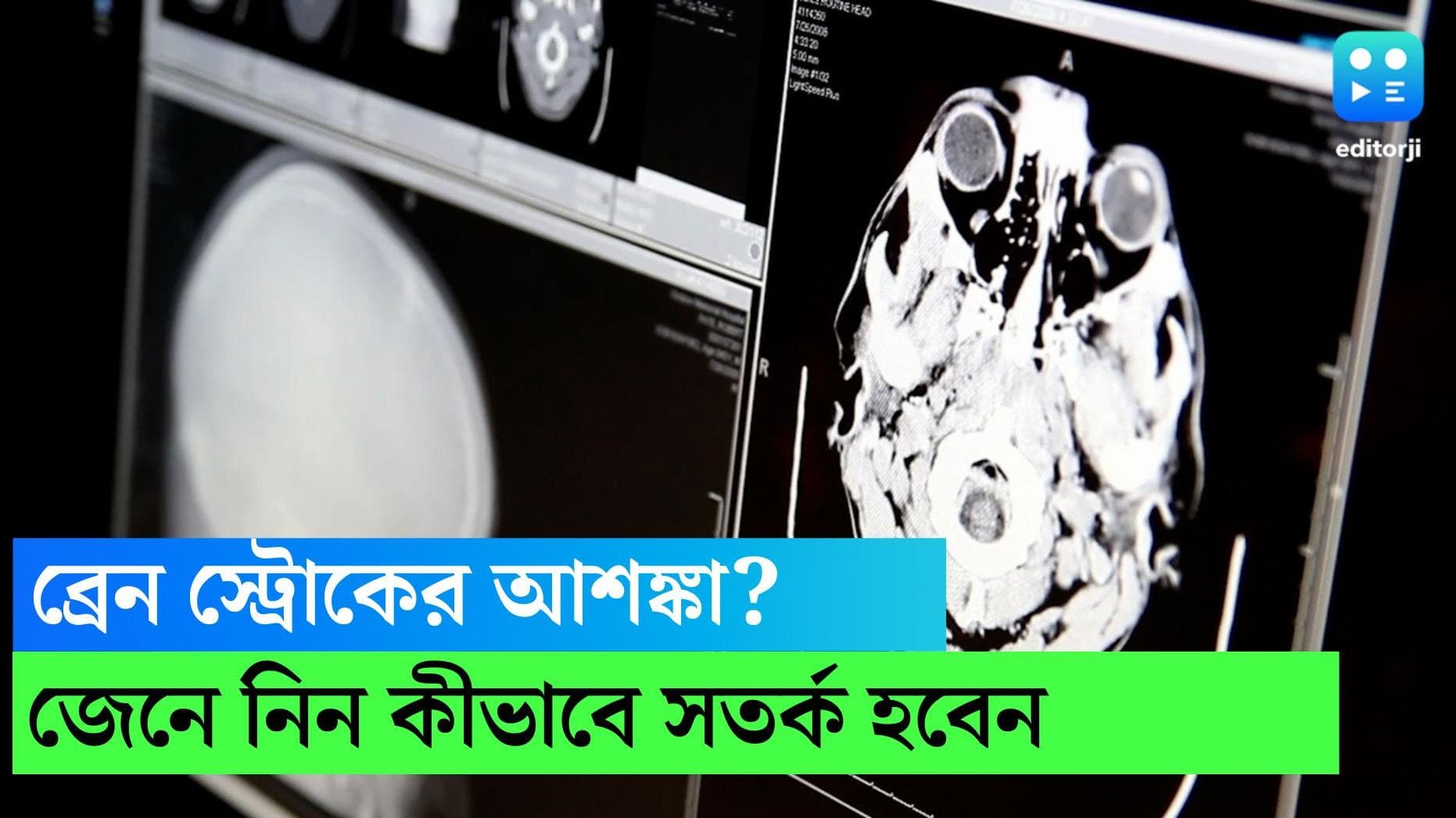 Brain Stroke Symptoms: ব্রেন স্ট্রোকের বিপদ এড়াতে আগে থেকে সতর্ক হবেন কীভাবে? রইল কিছু পরামর্শ