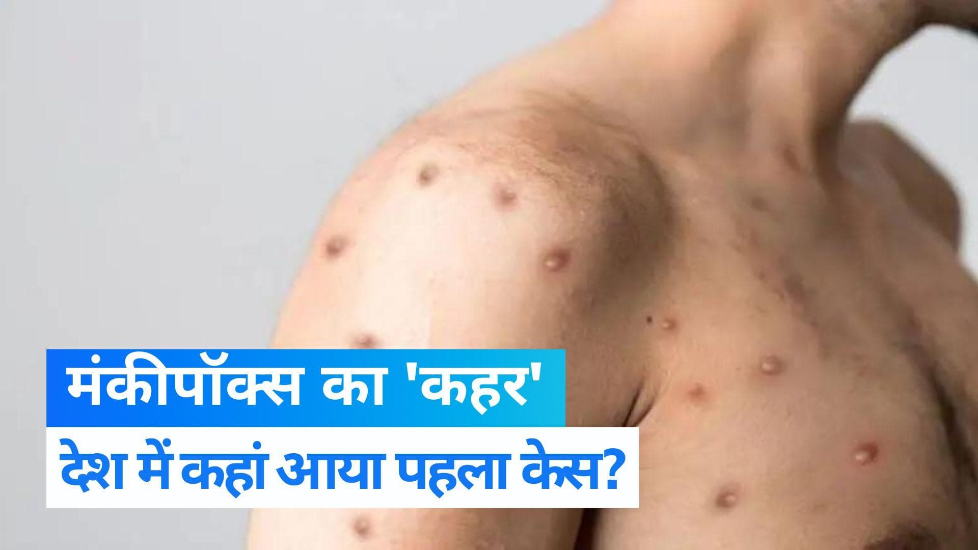 भारत में मिला Monkeypox का पहला मरीज,  जानें किस राज्य में आया पहला केस
