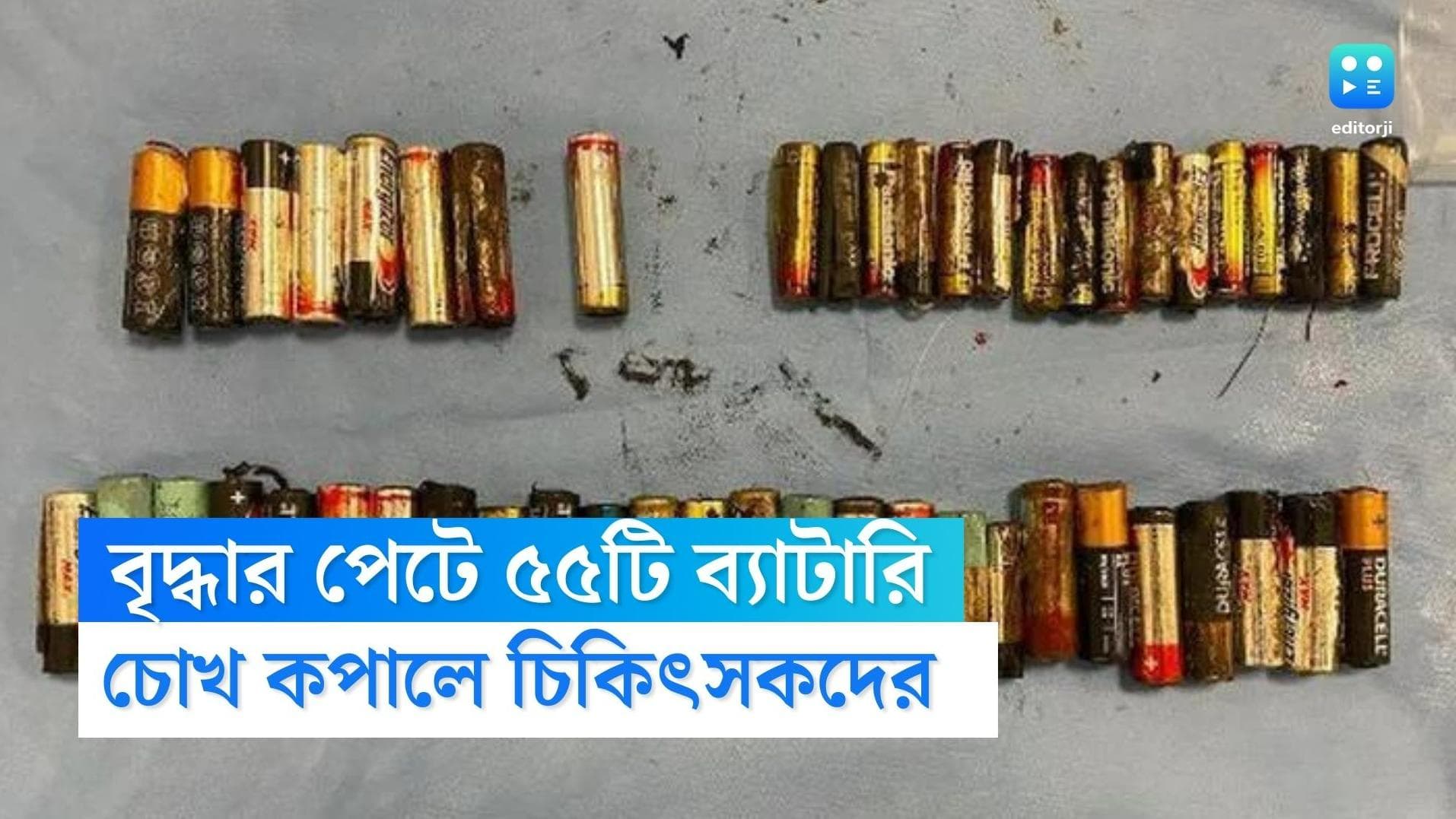 55 batteries in Woman's Stomach: বৃদ্ধার পেটে ৫৫টি ব্যাটারি! অস্ত্রোপচার করতে গিয়ে চোখ কপালে চিকিৎসকদের