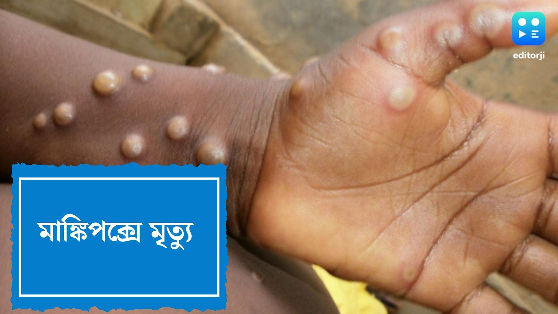 Monkeypox:আফ্রিকার বাইরে মাঙ্কিপক্সে প্রথম মৃত্যু, বাড়ছে আতঙ্ক
