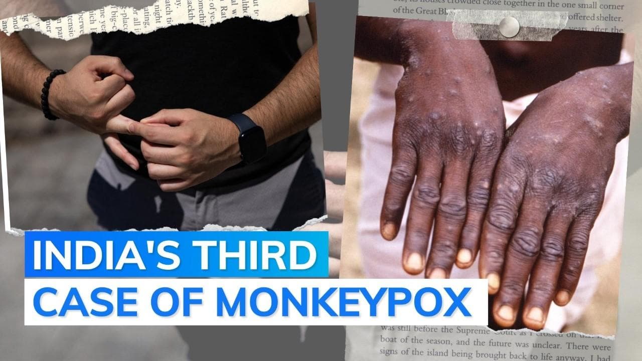 Kerala reports India's third Monkeypox case