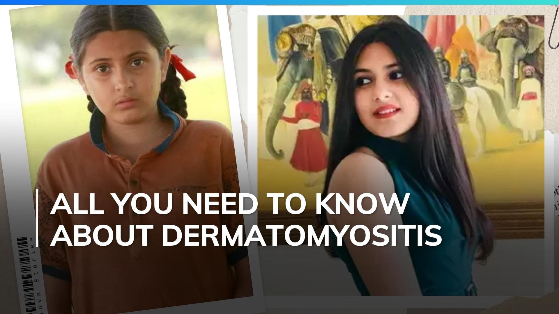 What is Dermatomyositis that Dangal actor Suhani Bhatnagar was suffering from? All you need to know