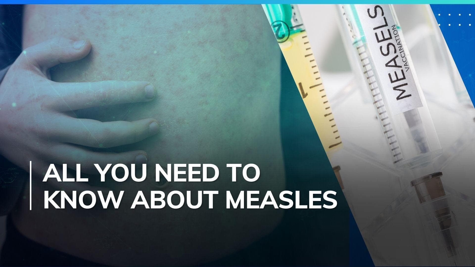 2 children die of Measles outbreak in MP: All you need to know about the disease
