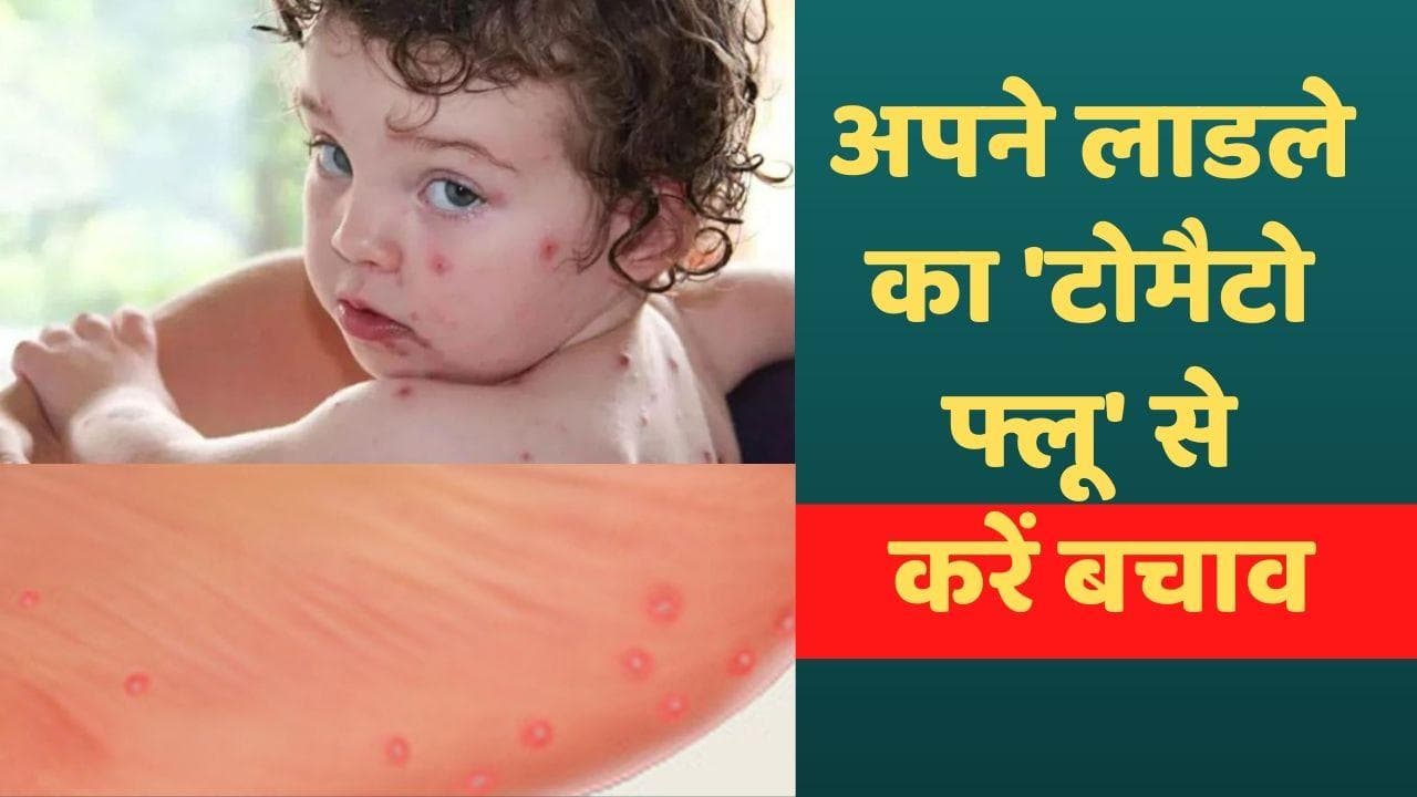 बच्चों में फैल रहा टोमैटो फीवर, 5 साल तक के बच्चों को ज्यादा खतरा, जानें टमाटर से क्या है कनेक्शन ?