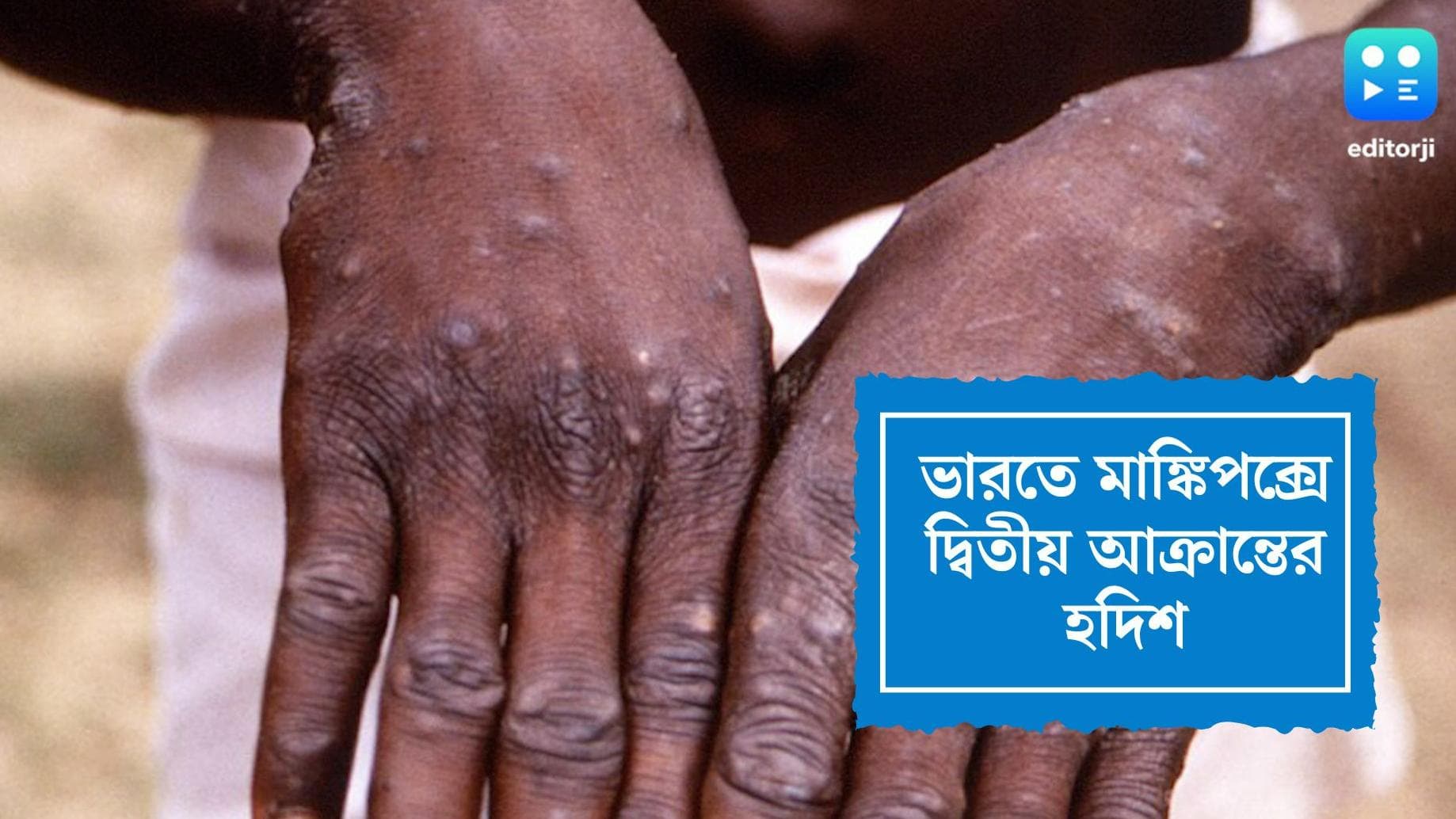 Monkey Pox Case: ভারতে মাঙ্কিপক্সে দ্বিতীয় আক্রান্তের হদিশ, কেরলের হাসপাতালে ভর্তি যুবক