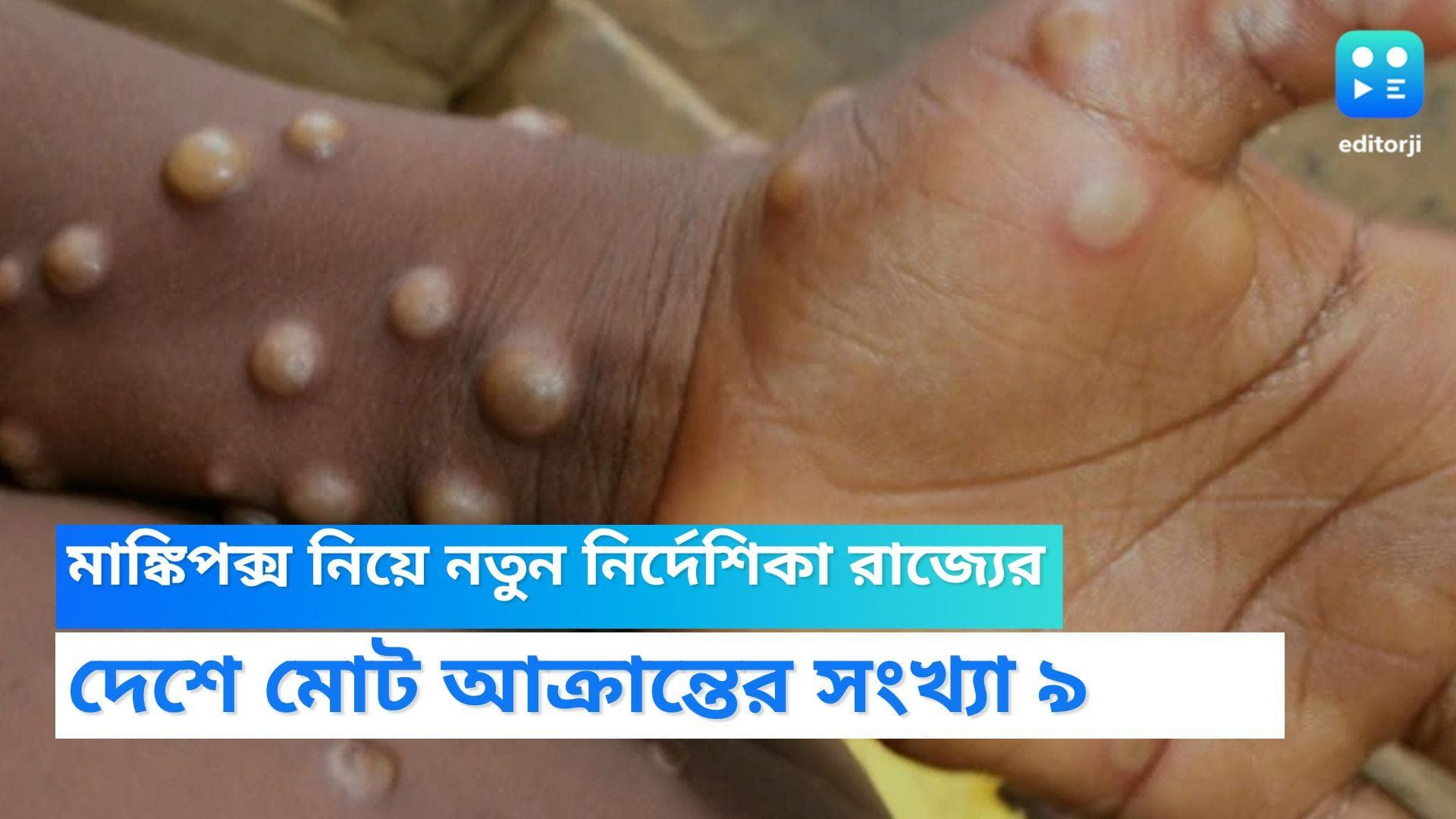 West Bengal Monkey Pox Guidelins:মাঙ্কিপক্স নিয়ে নতুন নির্দেশিকা রাজ্যের, দেশে মোট আক্রান্তের সংখ্যা ৯ 