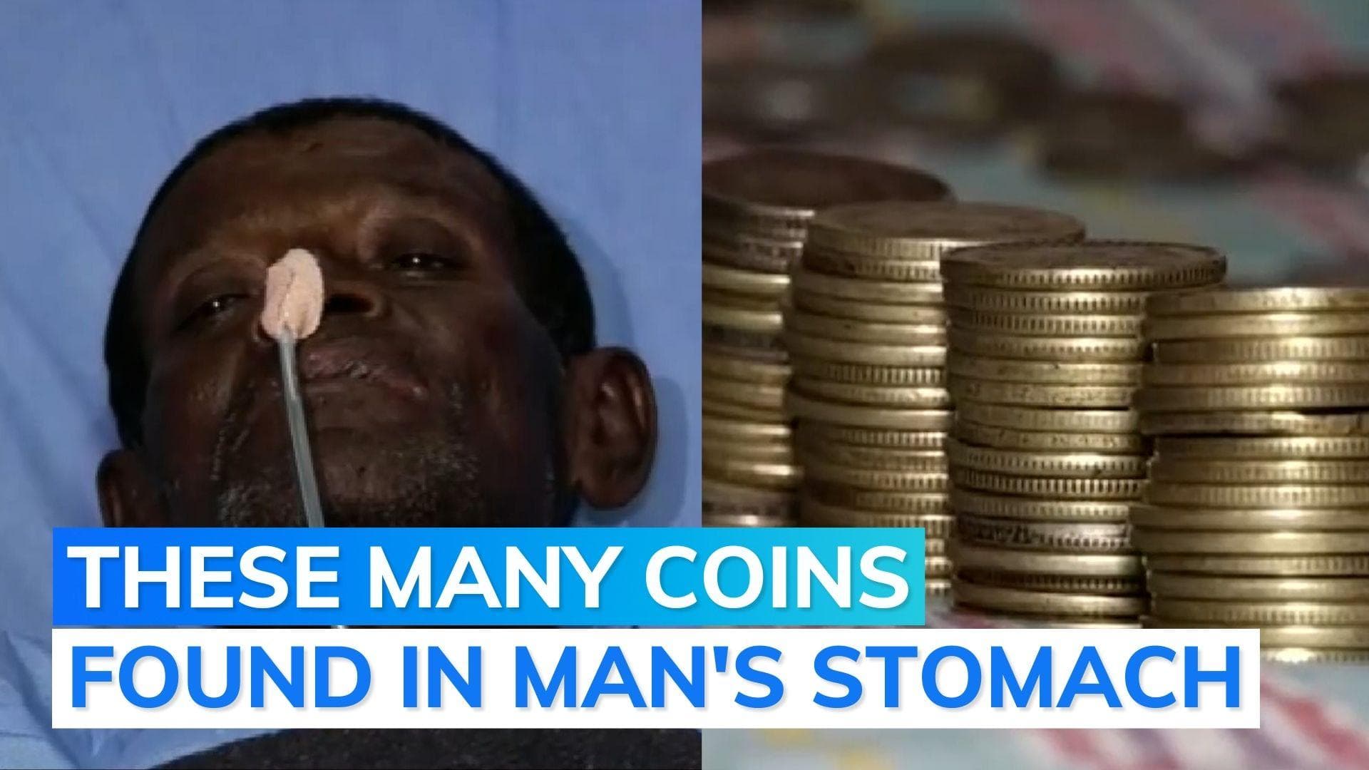 Karnataka: Doctors remove 187 coins from a patient's stomach