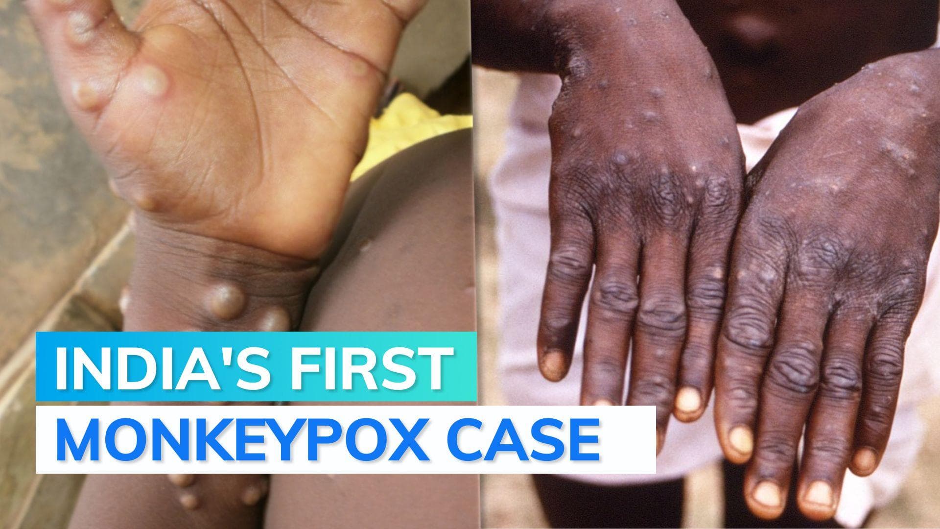India's first confirmed monkeypox case reported in Kerala