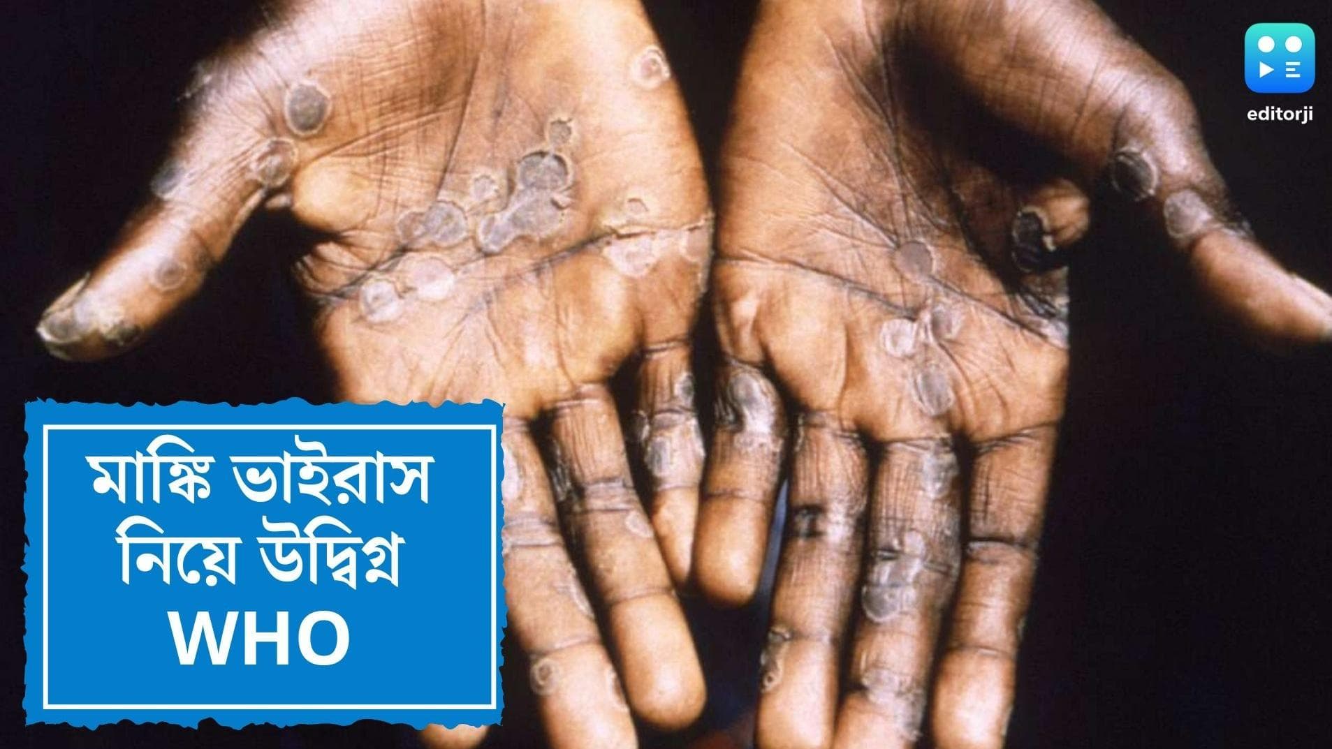 WHO on Monkey Virus:মাঙ্কি ভাইরাস সংক্রমণ হিমশৈলের চূড়া নয় তো? উদ্বিগ্ন ‘হু’