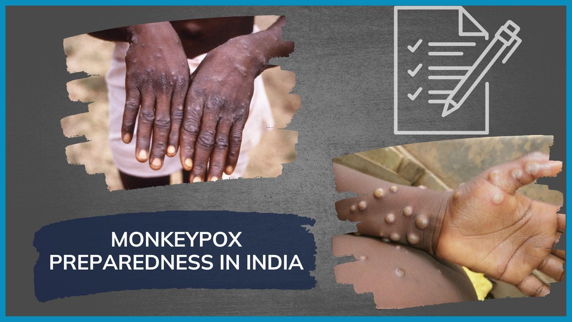 Uttarakhand sounds alert on monkeypox
