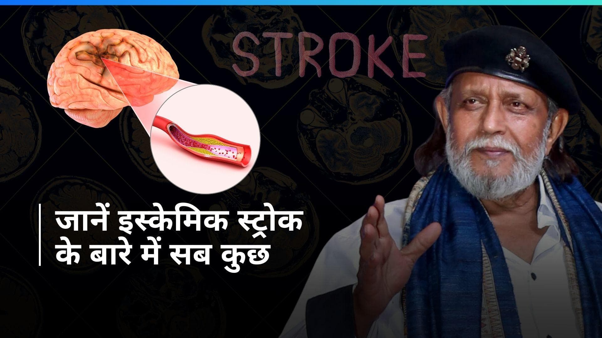 Ischemic Stroke: जानिए उस बीमारी के बारे में जिससे पीड़ित हैं Mithun Chakraborty, देखें इसके कारण व लक्षण