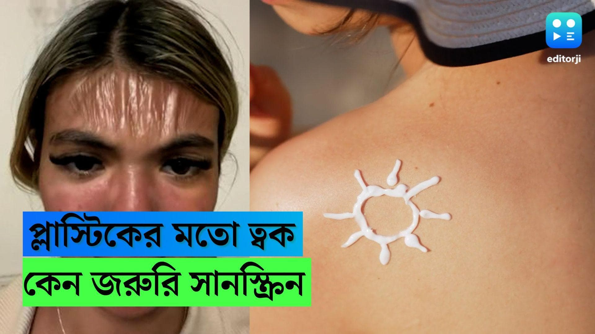 Sunscreen is necessary:চড়া রোদে ঘুম! প্লাস্টিকে বদলে গেল মহিলার ত্বক! জানেন, কেন সানস্ক্রিন মাখা জরুরি?