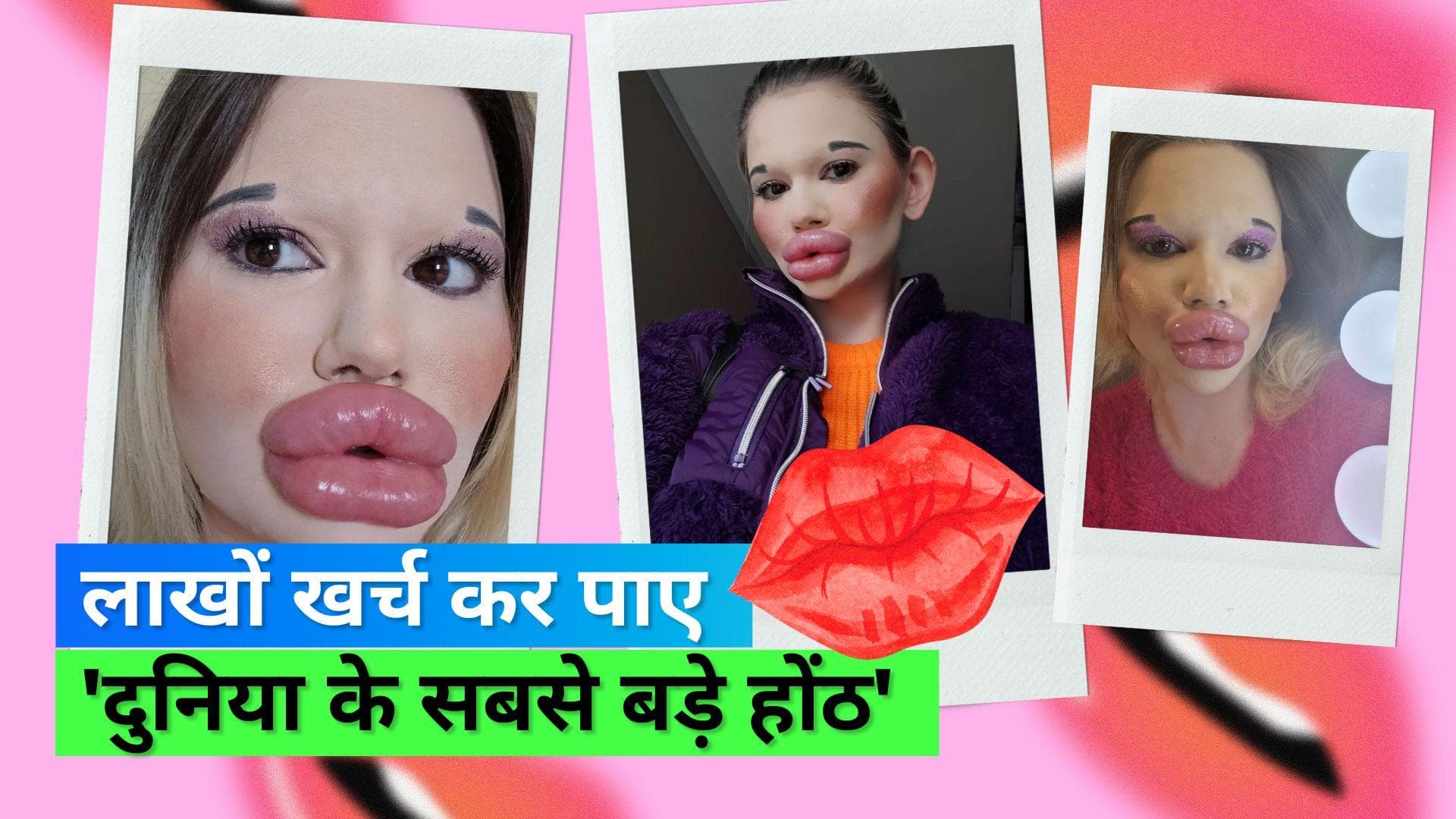 Lip Filler: दुनिया के सबसे बड़े होंठ पाने के लिए महिला ने खर्च किए लाखों रुपये, डॉक्टर दे चुके चेतावनी