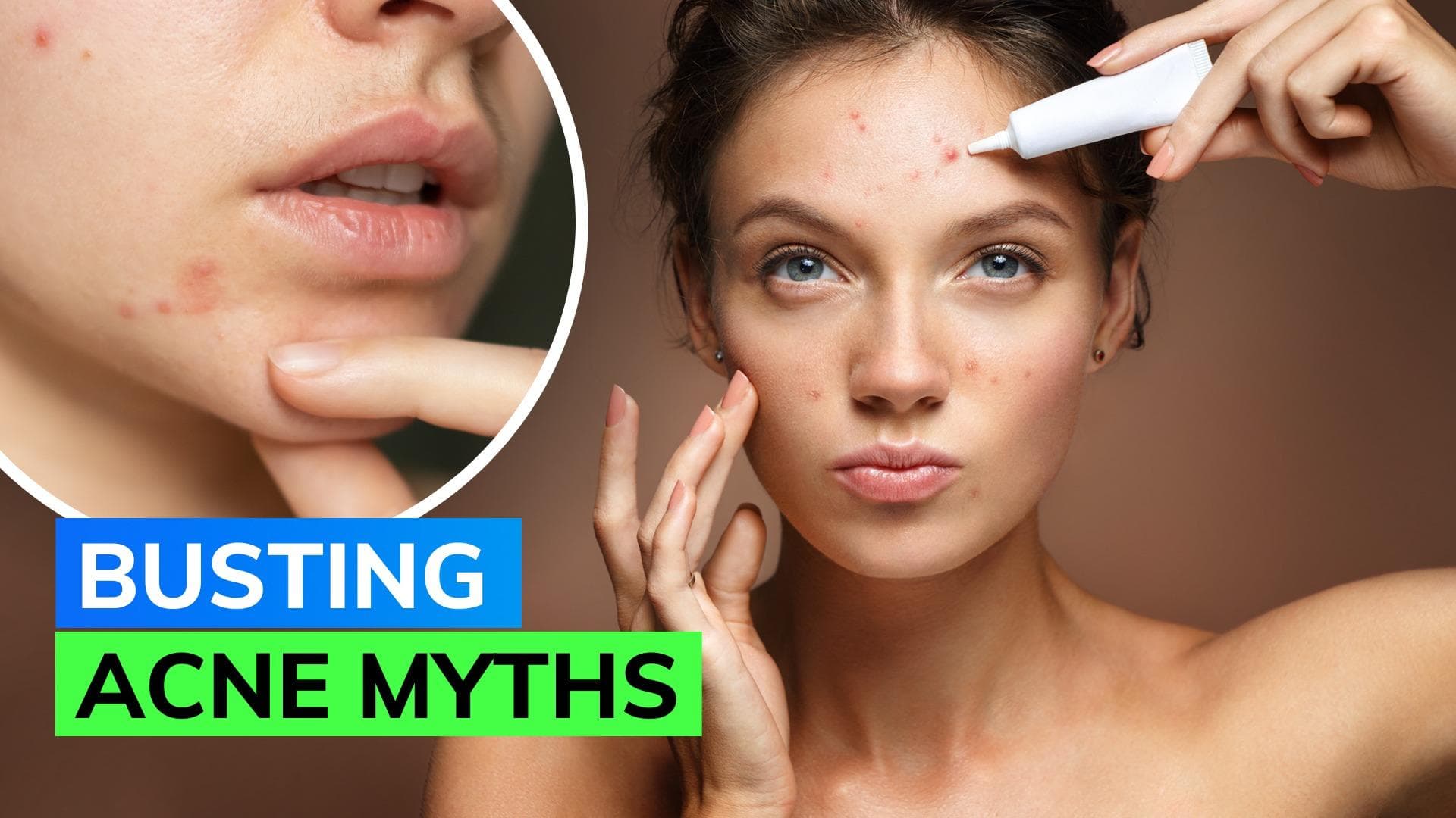 Dermatologist debunks common acne myths you should stop believing 