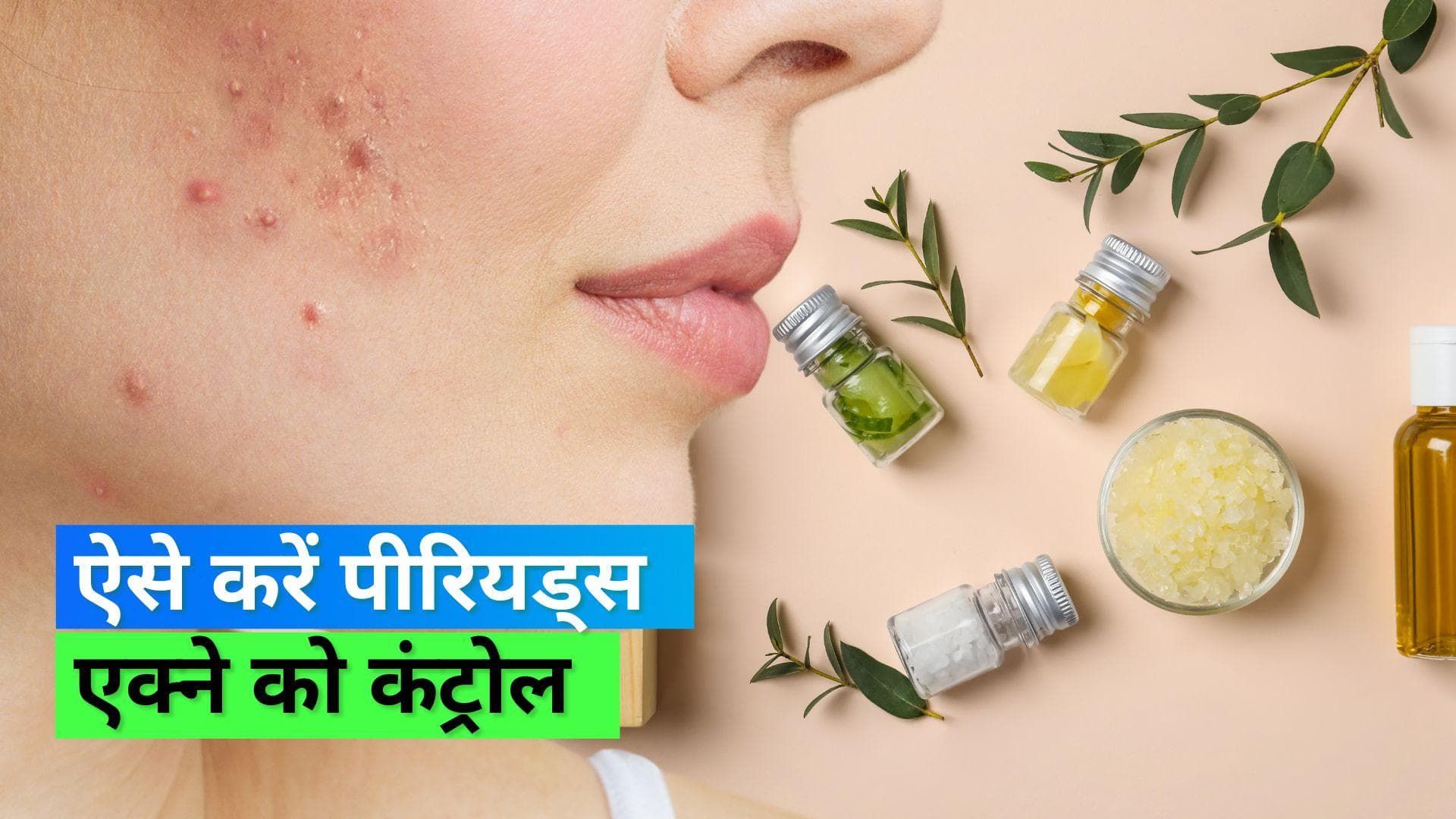 Menstrual Acne: पीरियड्स के समय होने वाले पिंपल्स से हैं परेशान, ये उपाय आएंगे आपके काम