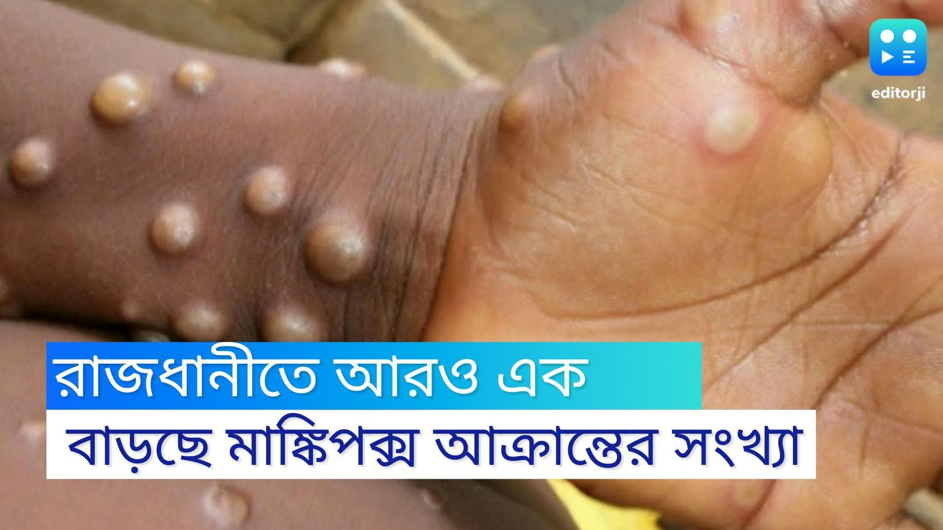  Monkeypox: দিল্লিতে আবারও মাঙ্কিপক্স আক্রান্তের সন্ধান, দেশে সংক্রমিত বেড়ে আট