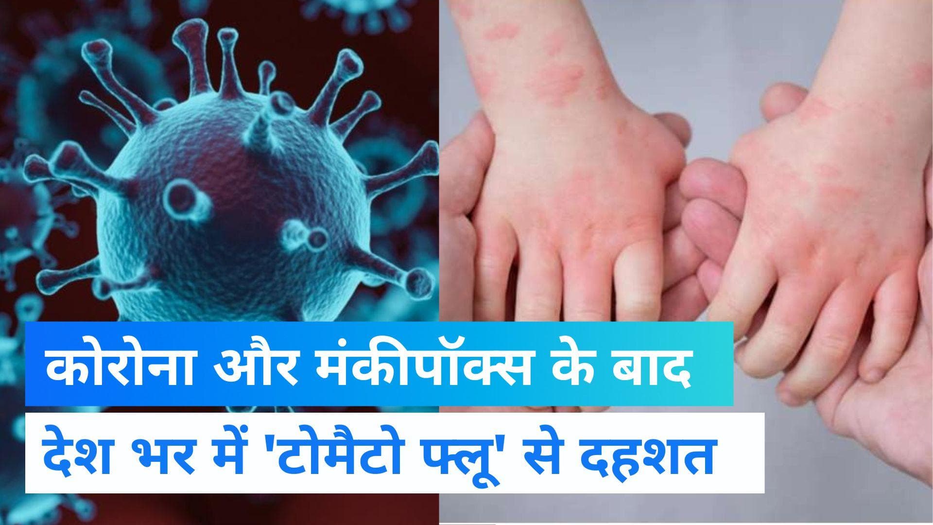 Tomato Flu :कोरोना और मंकीपॉक्स के बाद अब इस नई बीमारी ने दी देश में दस्तक, दहशत में लोग  