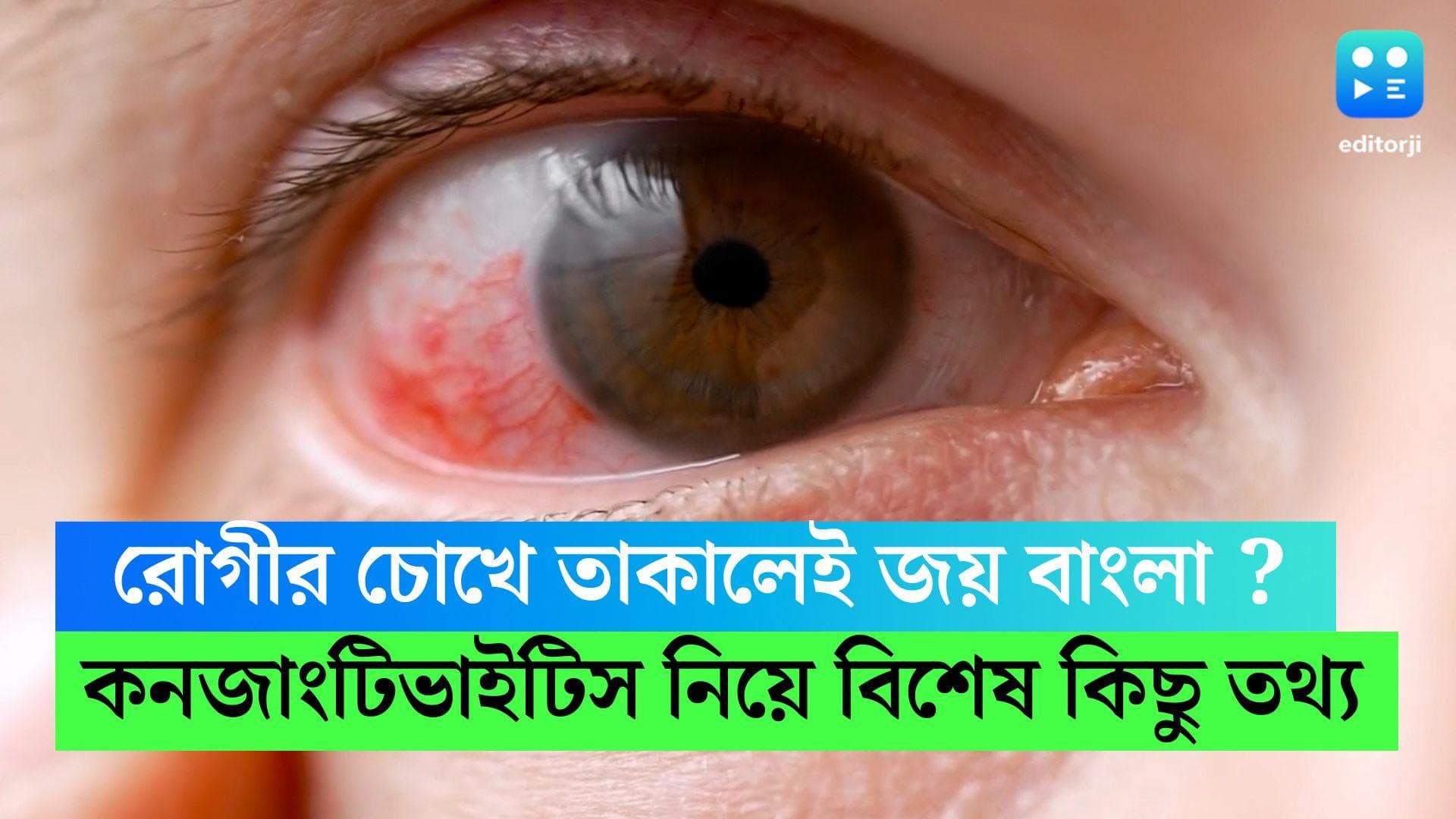 Conjunctivitis Symptoms : কনজাংটিভাইটিস ছড়ায় কীভাবে ? কী কী সাবধনতা অবলম্বন করবেন, জানাচ্ছেন চিকিৎসকরা 