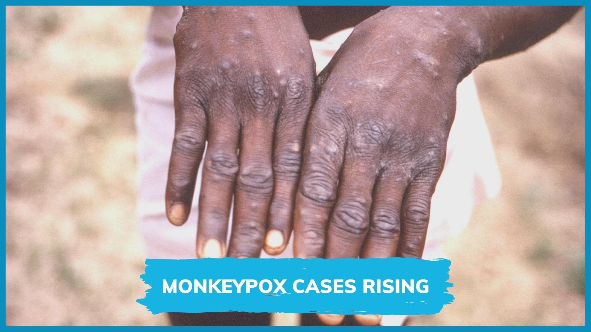 Monkeypox a 'real risk', WHO warns as cases cross 1000 globally
