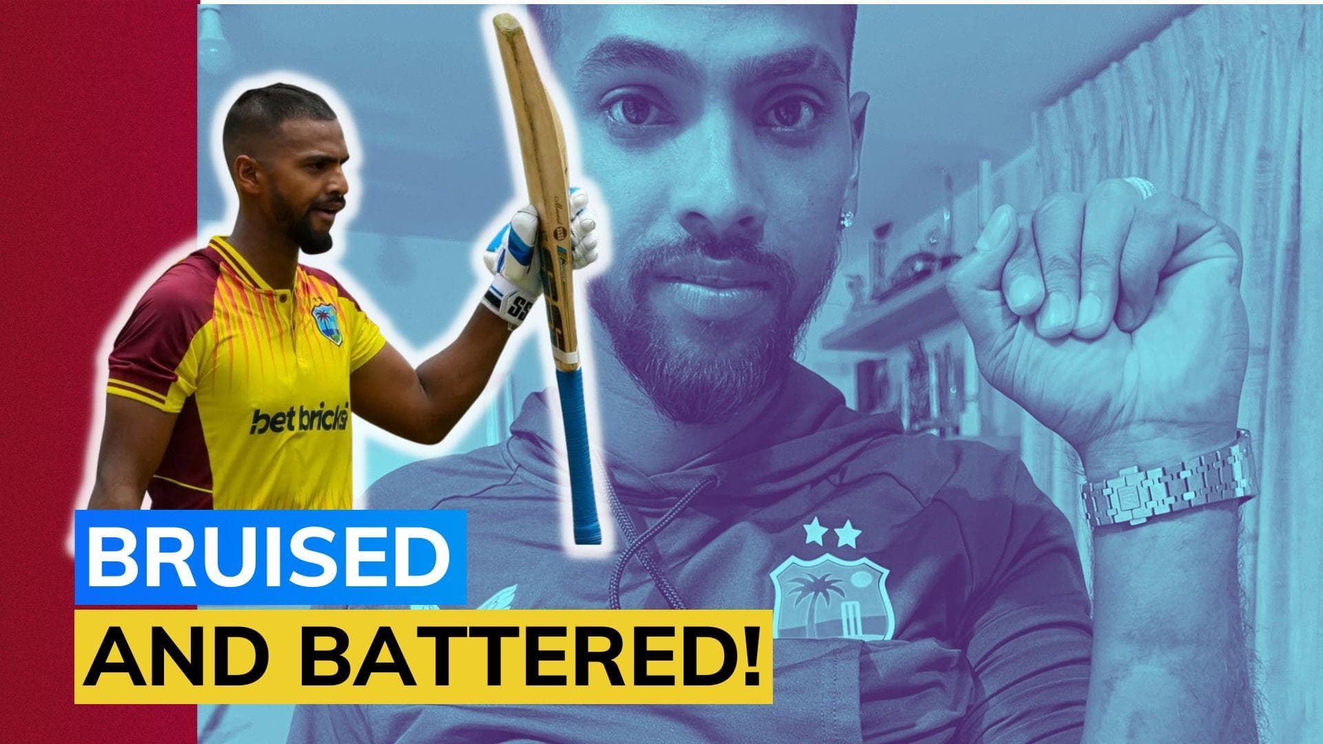 IND vs WI: Nicholas Pooran shows his bruises after getting hit by Arshdeep Singh and Brandon King