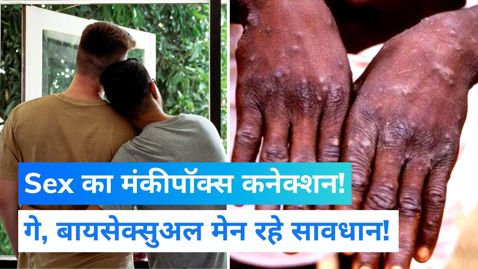 'SEX की गलती से होगा Monkeypox',  WHO ने जारी की पुरुषों के लिए गाइडलाइंस