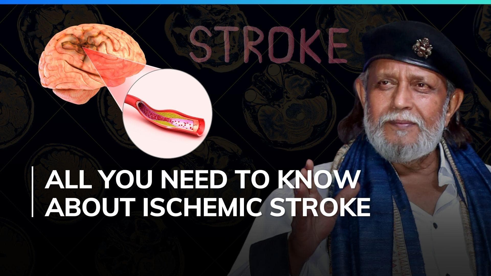 Mithun Chakraborty suffers Ischemic Cerebrovascular Stroke: All you need to know about the condition