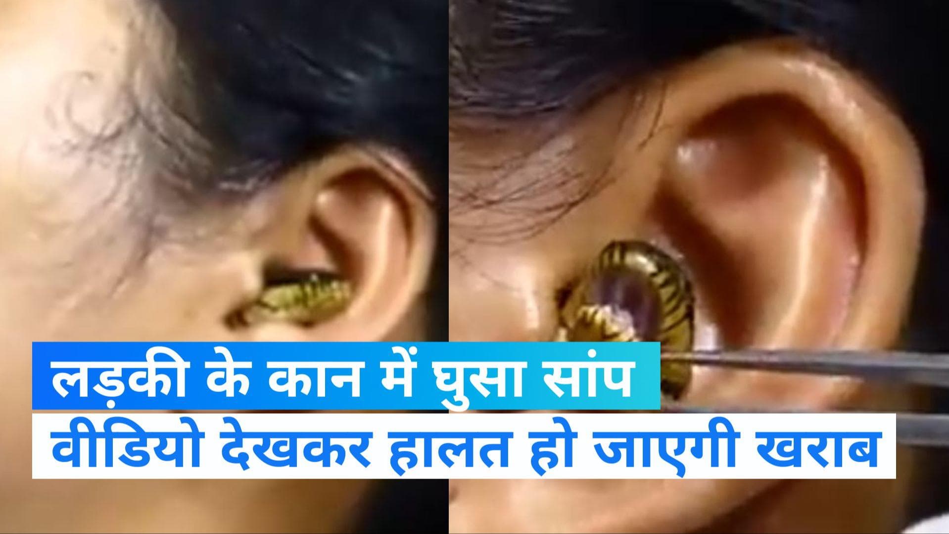 Viral Video: लड़की के कान के अंदर घुस गया सांप, चिमटे से निकालता दिखा डॉक्टर