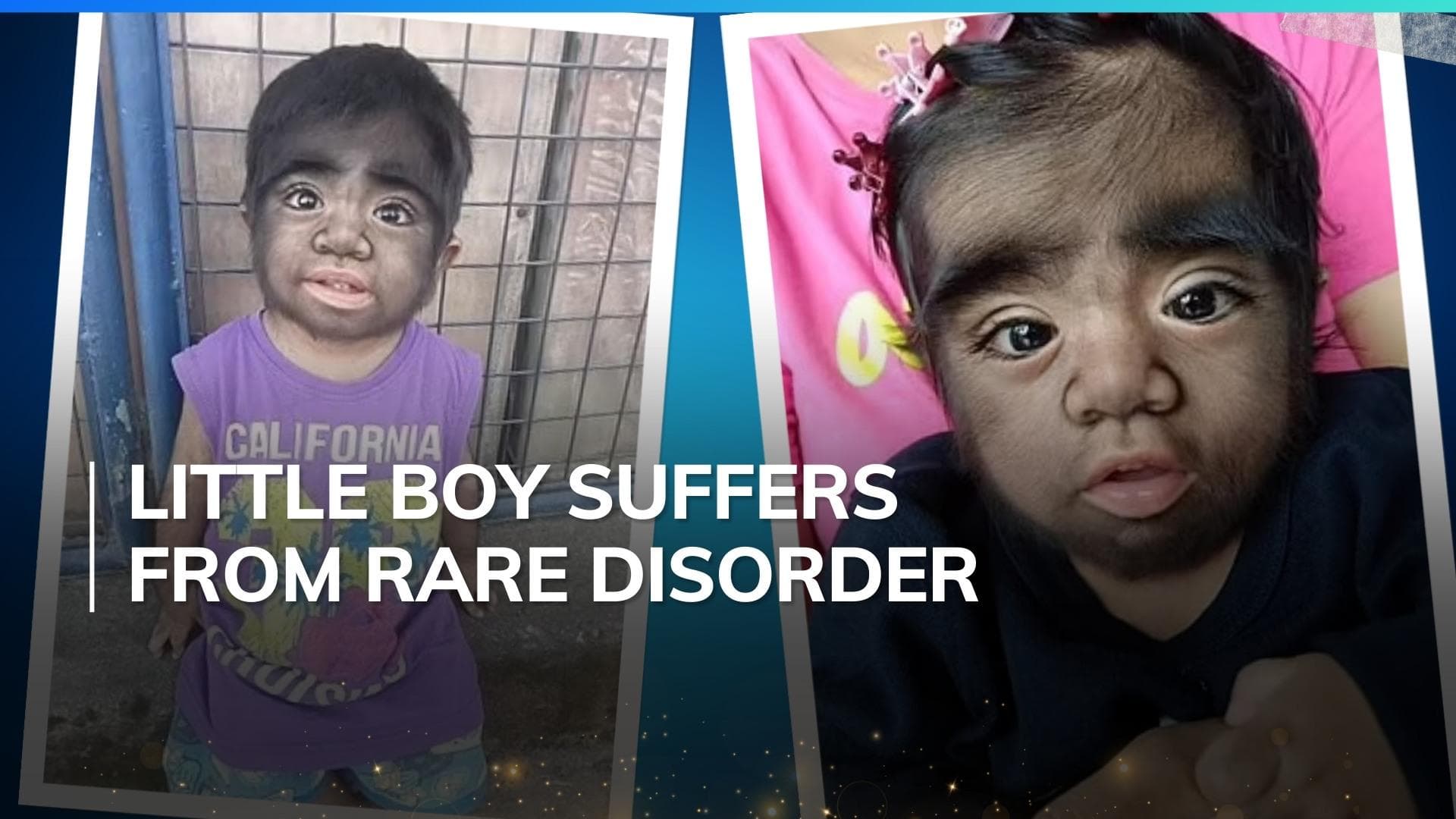 Hairiest baby in the world! Little boy diagnosed with rare 'Werewolf Syndrome', mom blames 'wild cat'