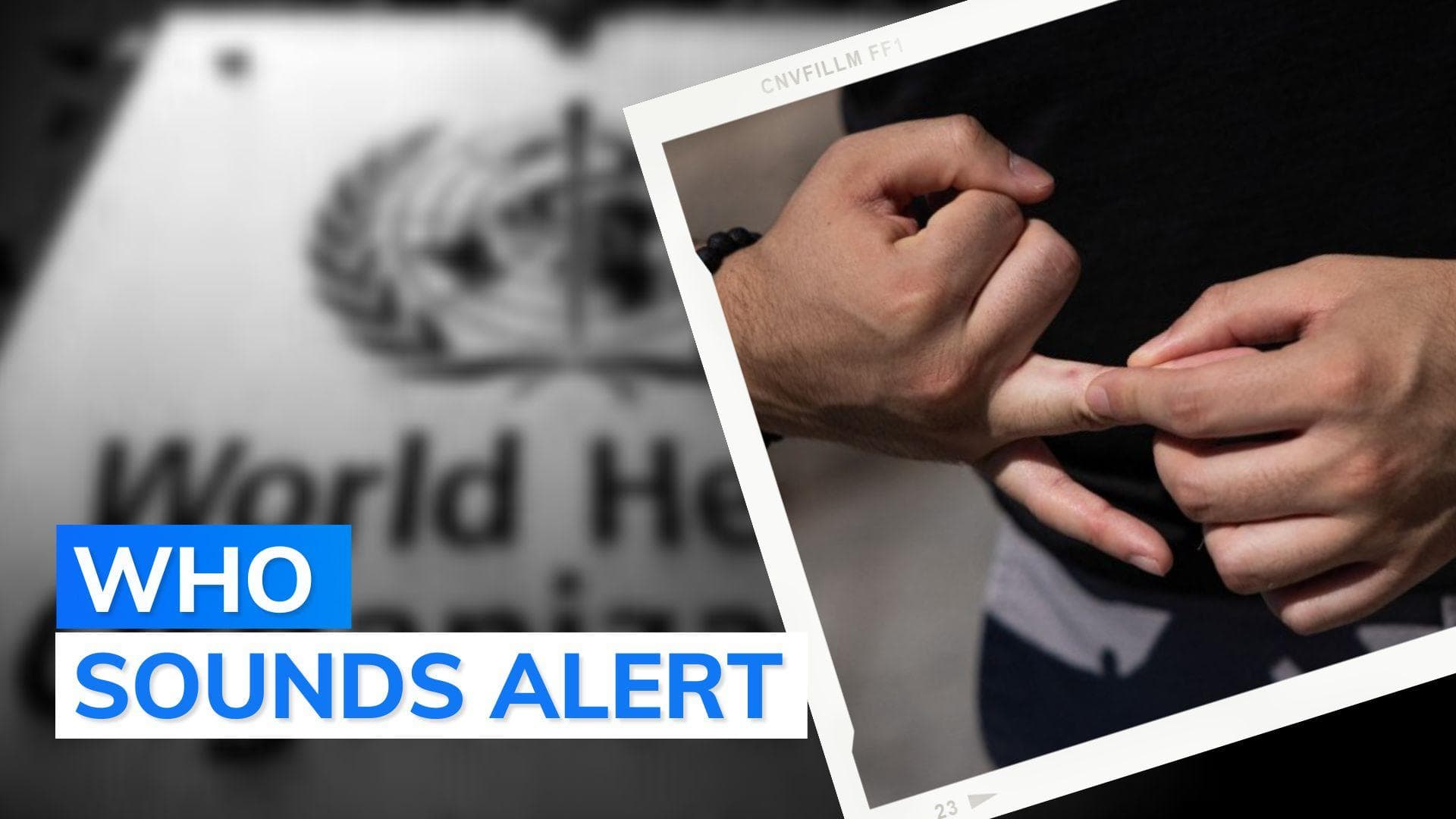 World Health Organisation declares monkeypox global public health emergency