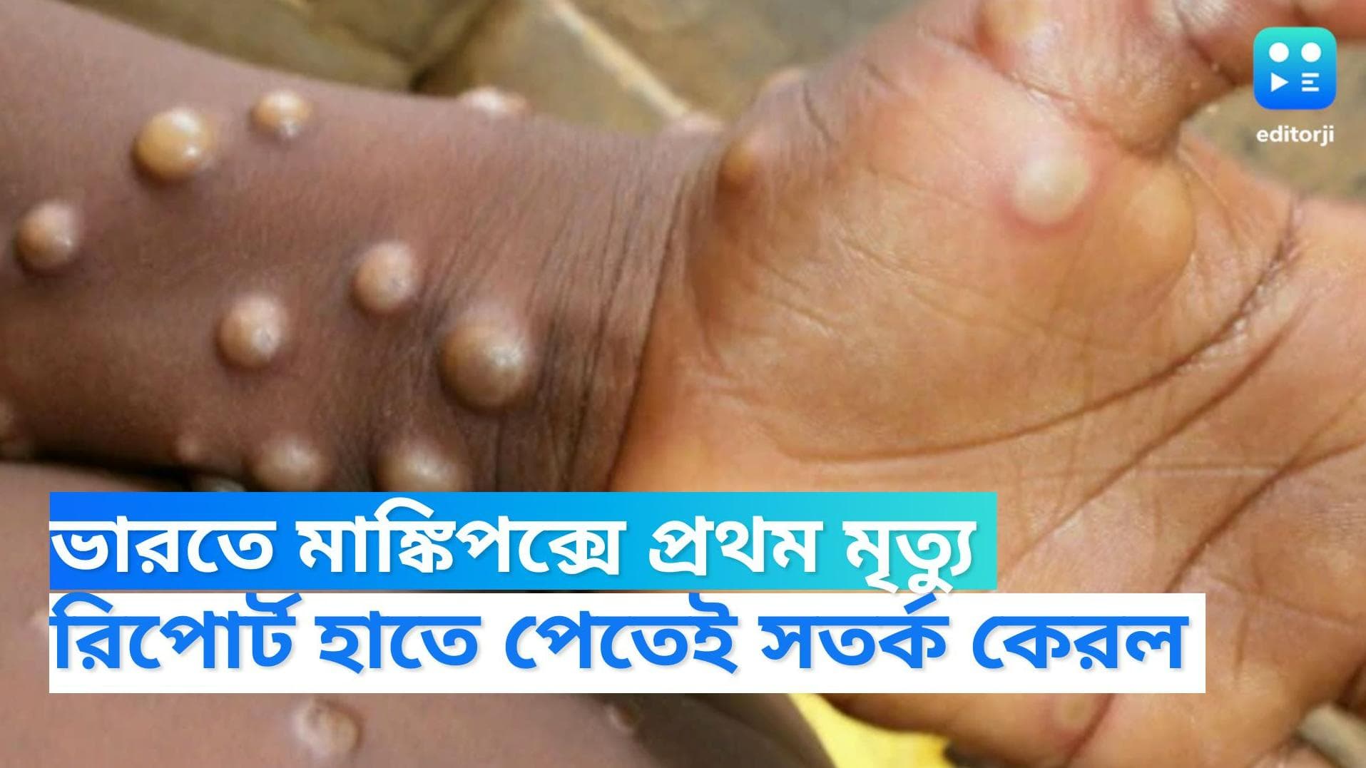 Monkeypox in Kerala: মাঙ্কিপক্সেই কেরলের যুবকের মৃত্যু, জানাল পুণের ন্যাশনাল ইনস্টিটিউট অফ ভাইরোলজি