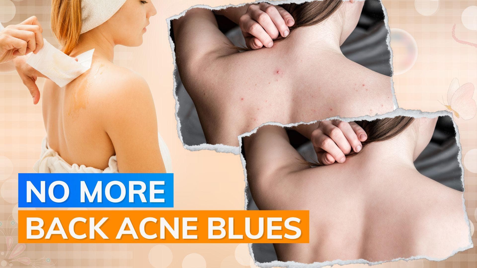 Say goodbye to post-waxing back acne with dermatologist-approved solutions