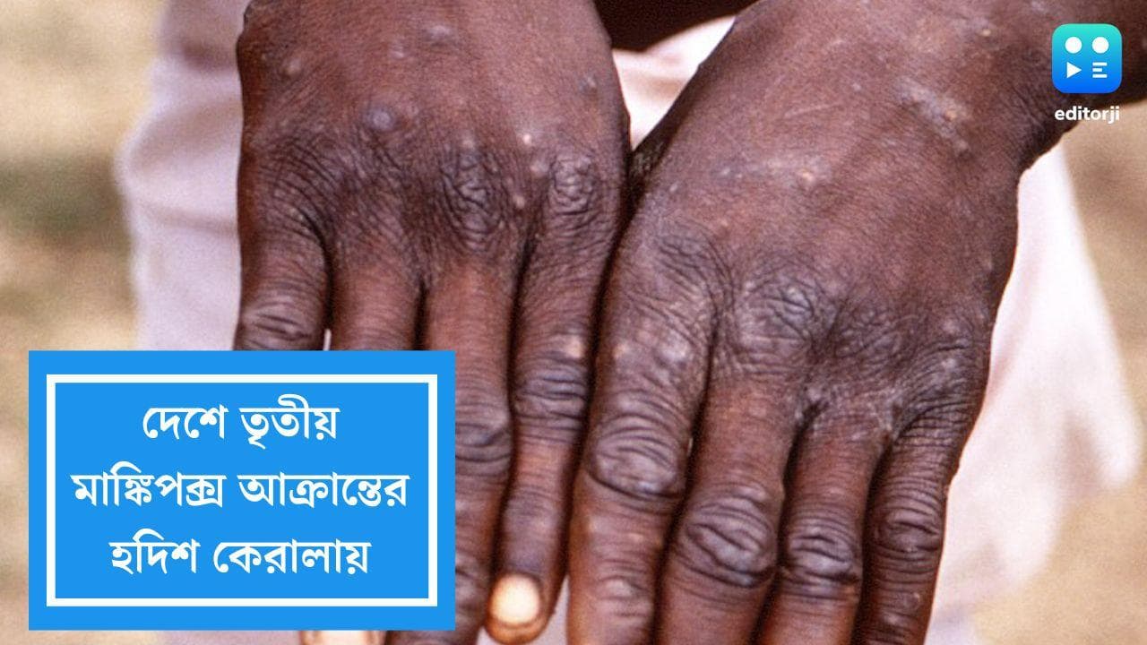 Monkeypox Case in India: দেশে তৃতীয় মাঙ্কিপক্স আক্রান্তের হদিশ মিলল কেরালায়