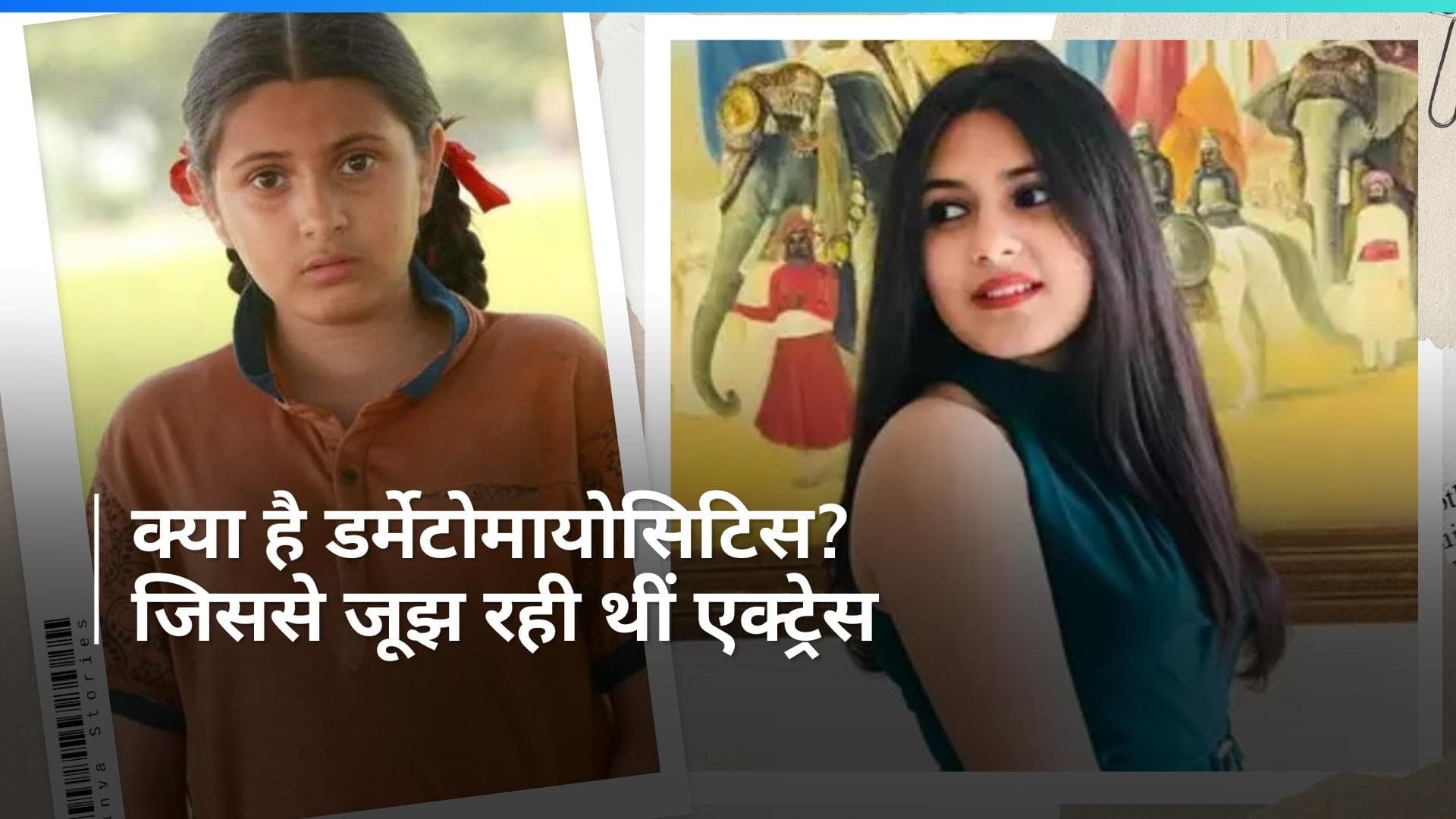 Dermatomyositis: डर्मेटोमायोसिटिस की वजह से हुआ दंगल गर्ल का निधन, जानिए क्या है ये बीमारी