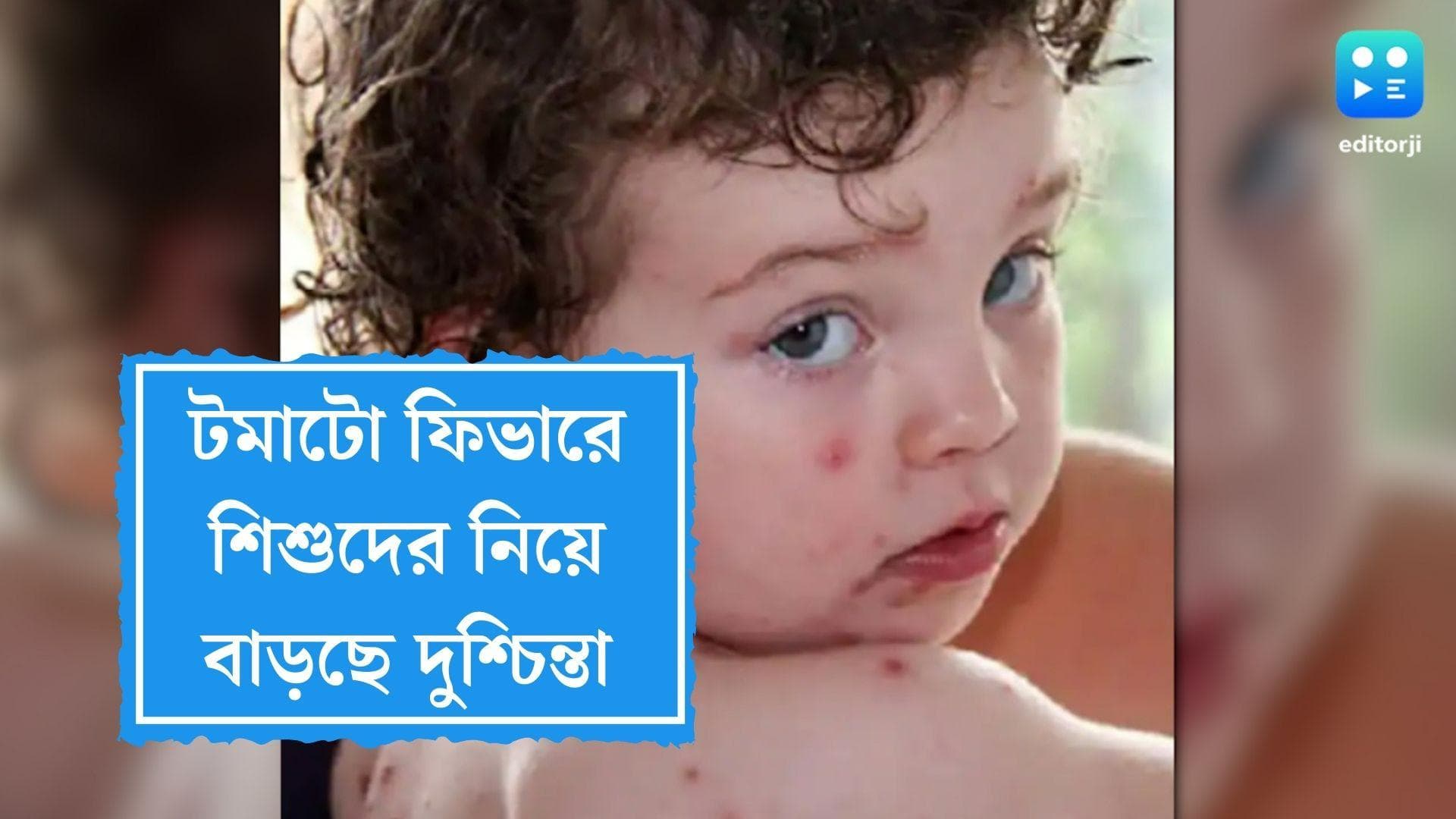 Tomato Fever in Kerala: টমাটো ফিভারে আক্রান্ত ৫ বছরের কম বয়সি শিশুরা, দুশ্চিন্তা বাড়ছে কেরলে