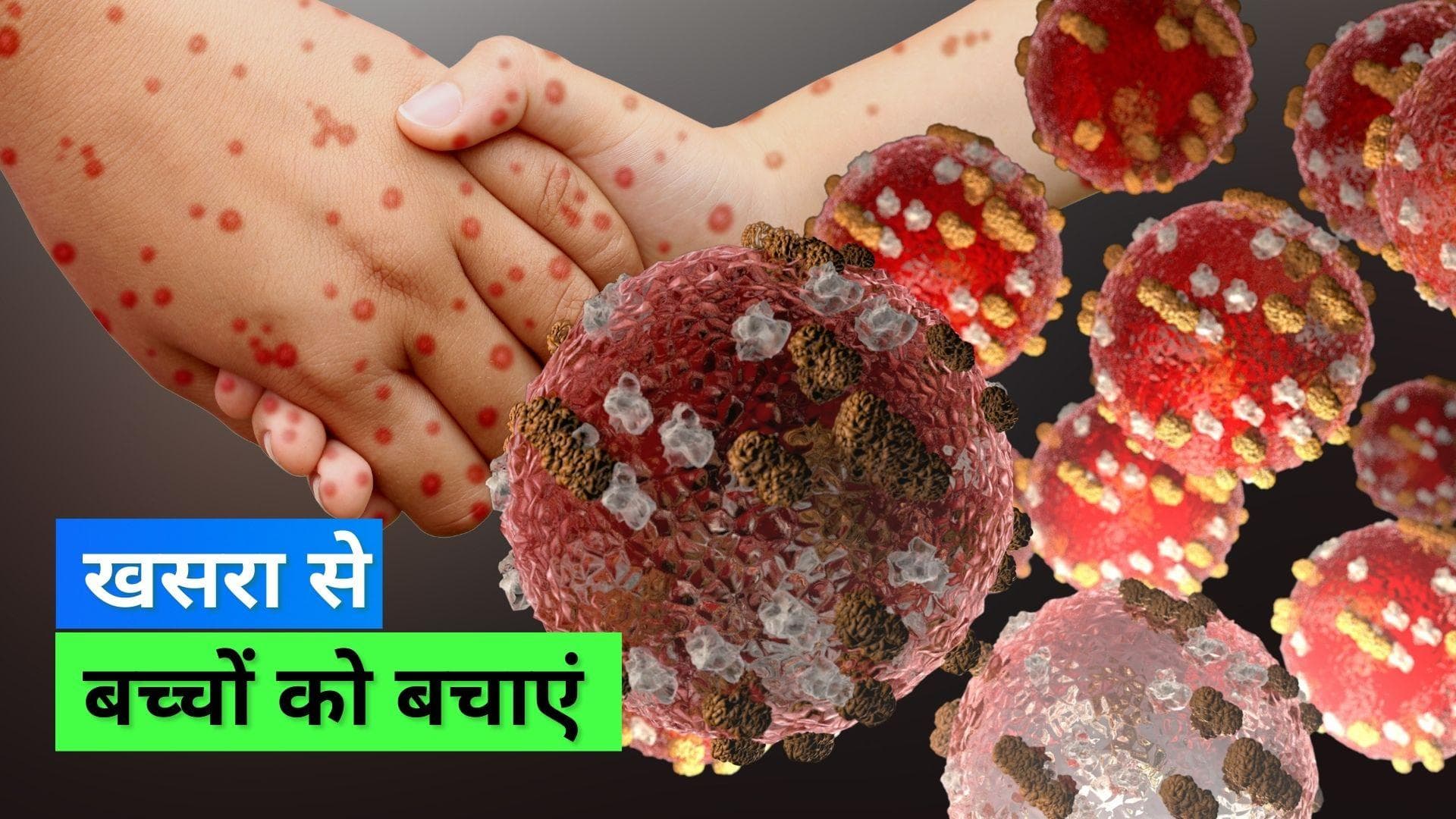 Measles Outbreak: मुंबई में अचानक बढ़े खसरा के मामले, इन लक्षणों को पहचान कर अपने बच्चों को इससे बचाएं